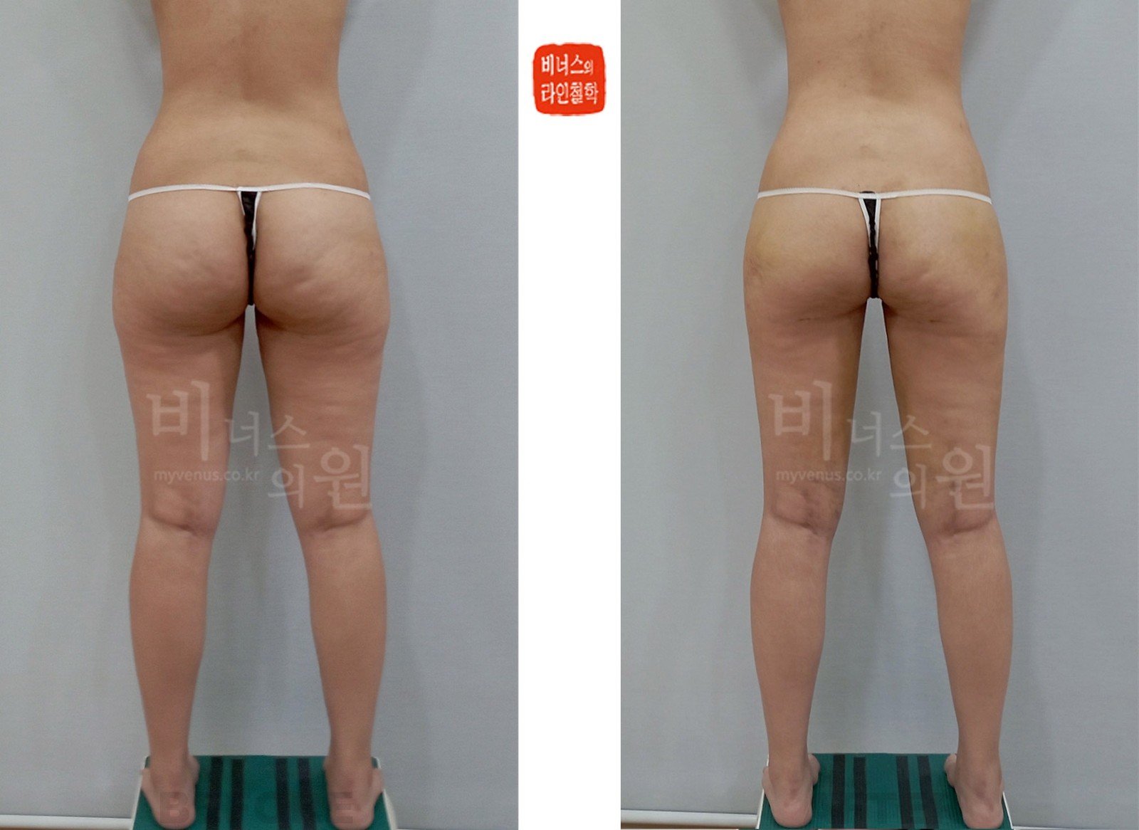 원통형 허벅지와 엉덩이 지방흡입 전후사진 첫 번째 케이스 후면 (수술 후 1주)