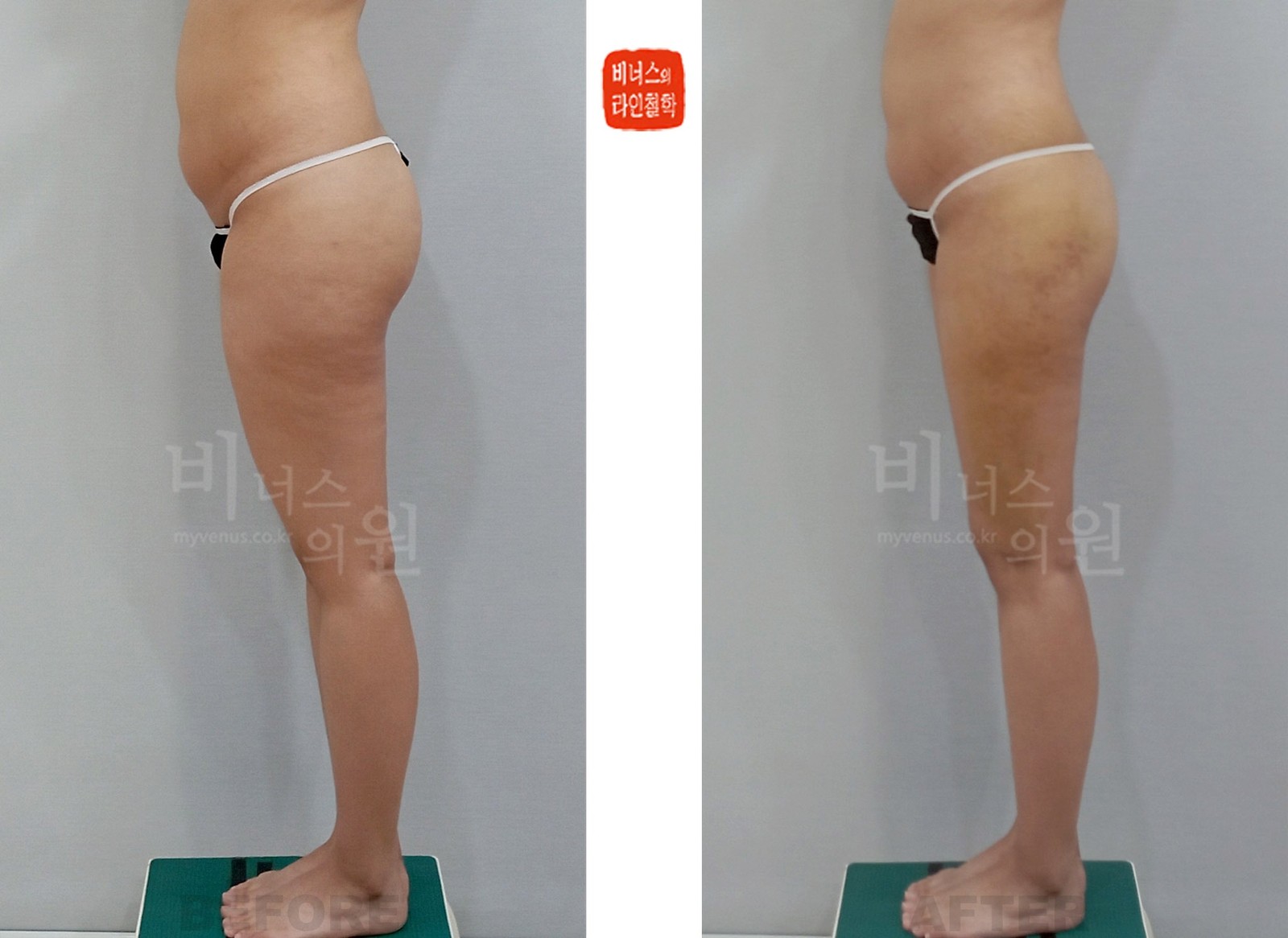 원통형 허벅지와 엉덩이 지방흡입 전후사진 첫 번째 케이스 좌측면 (수술 후 1주)