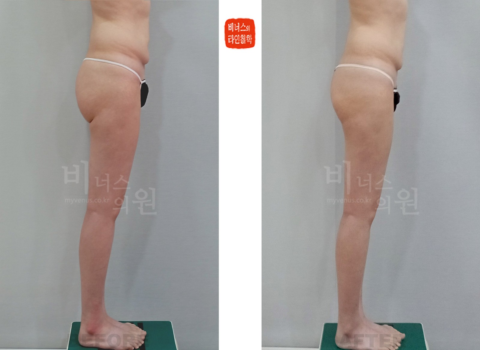 허벅지 이중주름 교정 엉덩이 지방흡입·지방이식 전후사진 오른쪽 측면 (수술 후 1주일)