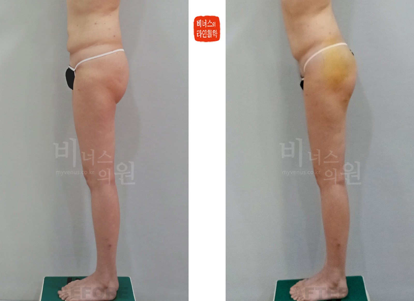허벅지 이중주름 교정 엉덩이 지방흡입·지방이식 전후사진 왼쪽 측면 (수술 후 1주일)