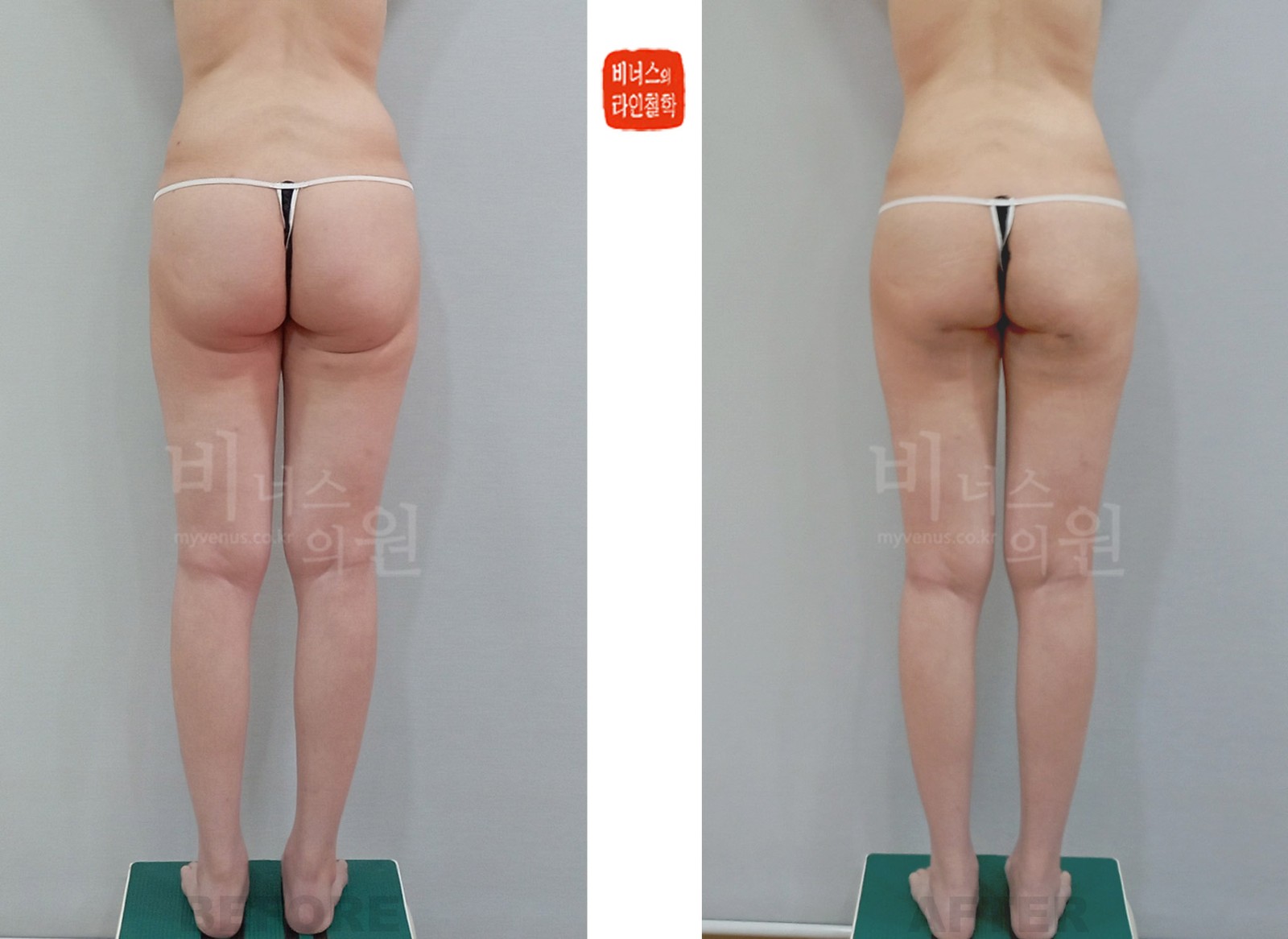 허벅지 이중주름 교정 엉덩이 지방흡입·지방이식 전후사진 후면 (수술 후 1주일)