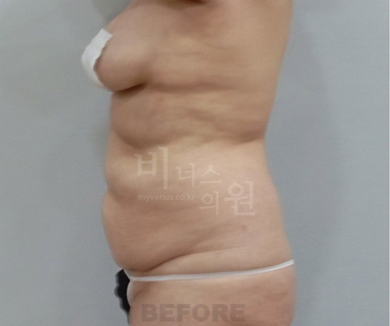 복부 지방흡입 수술 전 측면
