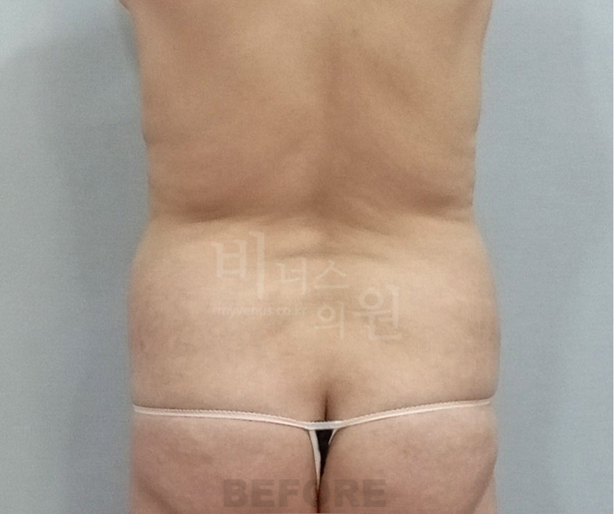 복부 지방흡입 수술 전 후면