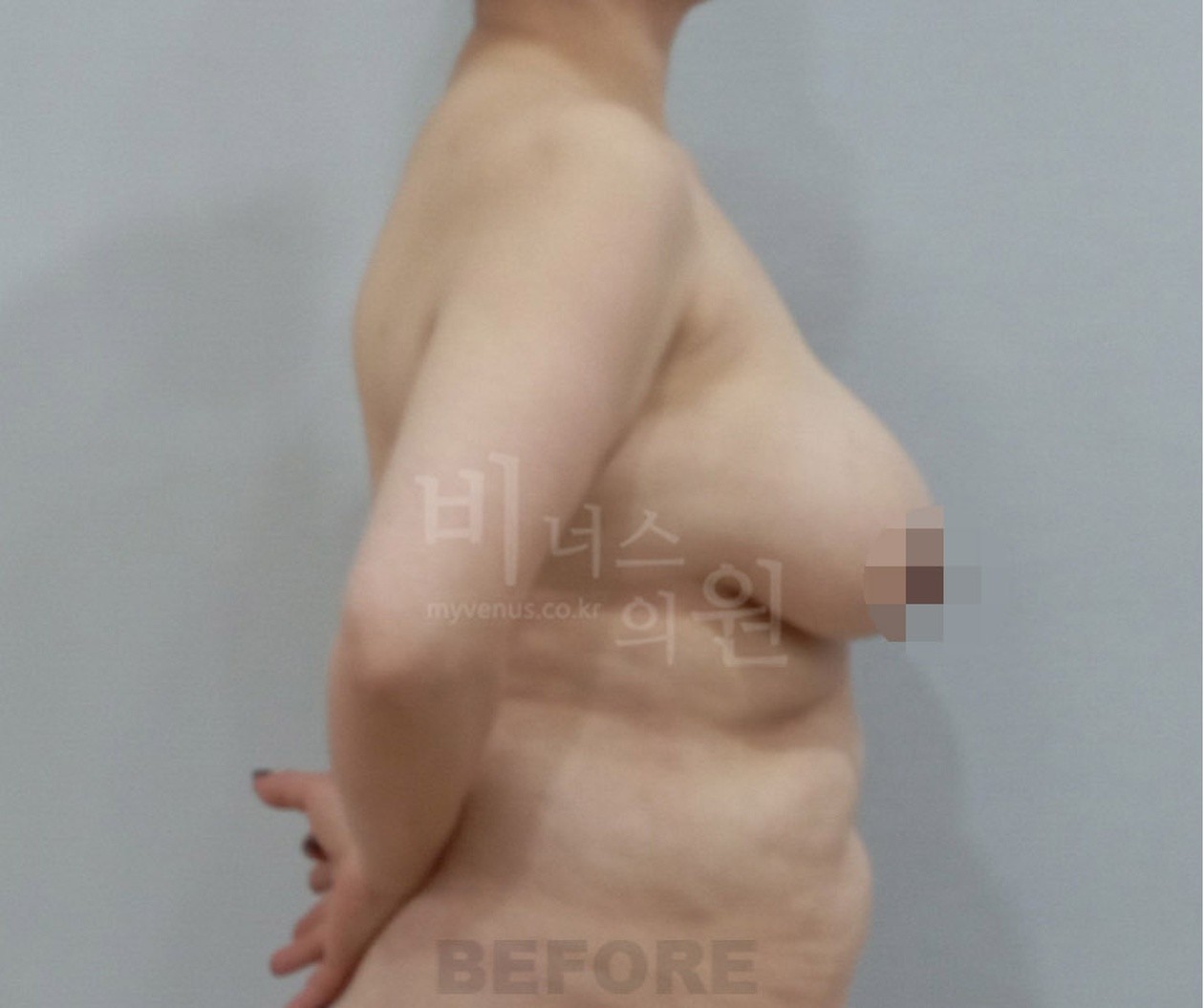 유방 지방흡입 수술 전 측면