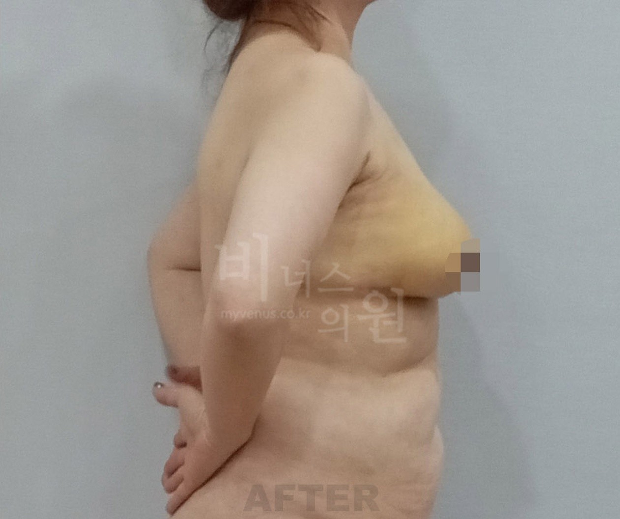 유방 지방흡입 수술 후 측면