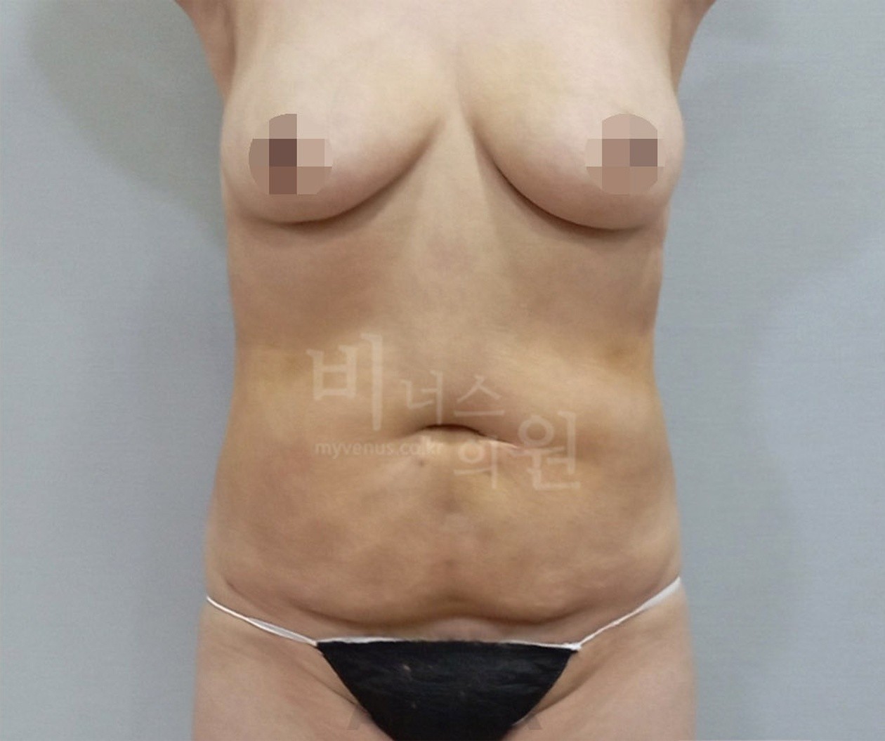 복부 지방흡입 수술 후 정면