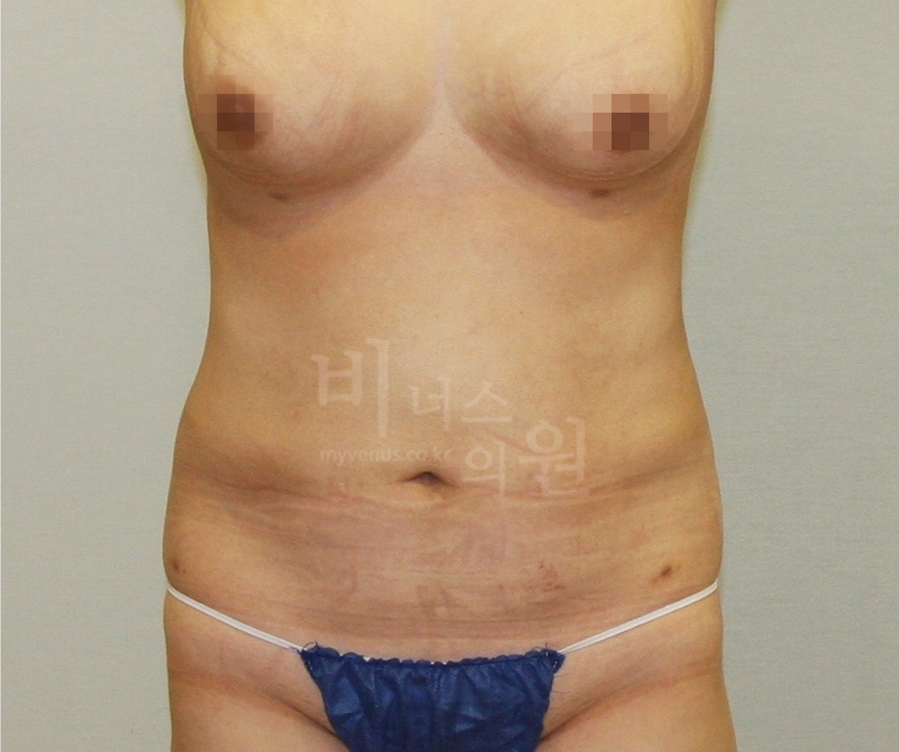 복부 지방흡입 후 정면 (2012년 촬영)