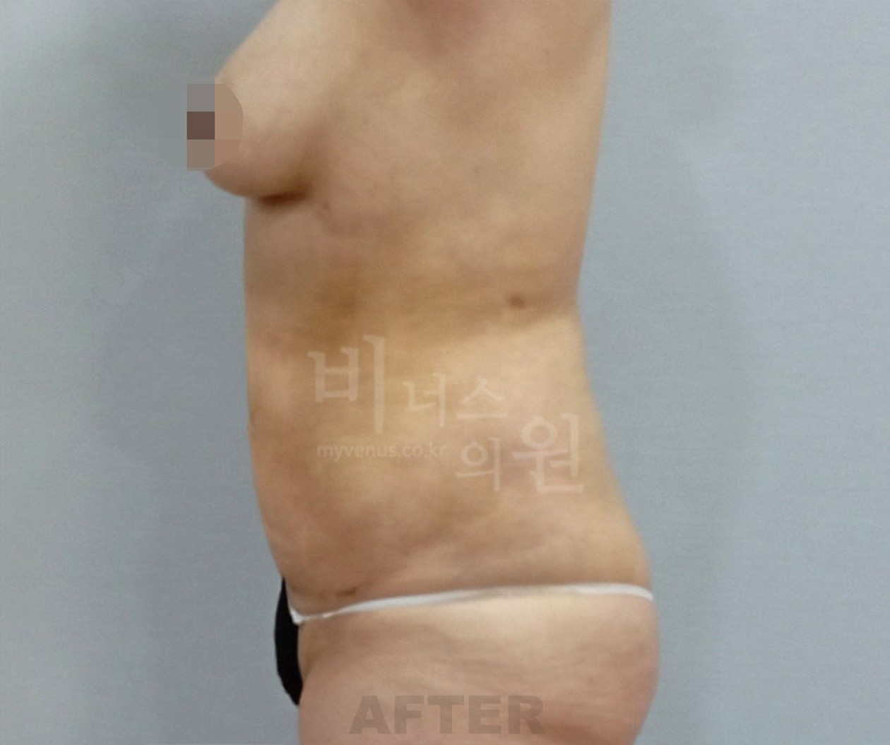 복부 지방흡입 수술 후 측면