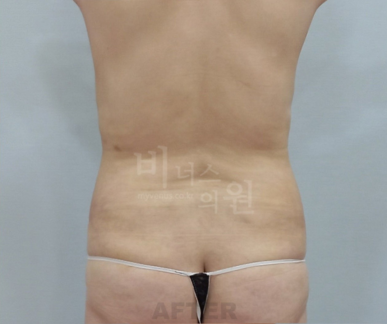 복부 지방흡입 수술 후 후면