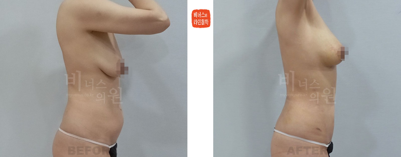 복부 지방흡입과 유방 지방이식 전후사진 우측면 (수술 후 1주일)