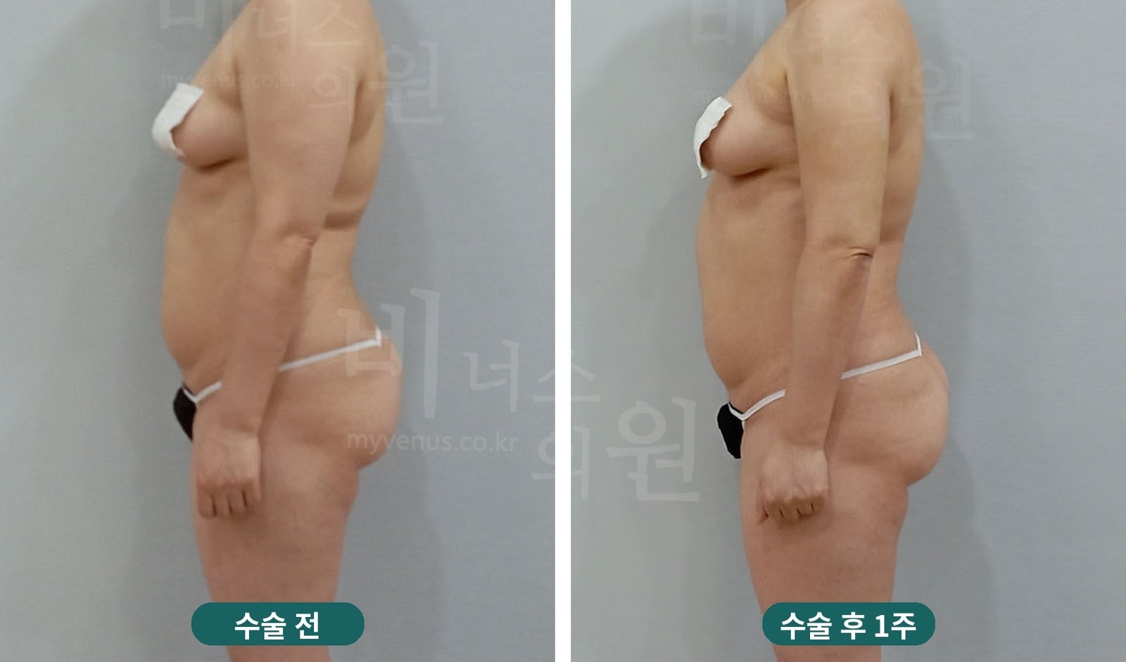 팔 지방흡입 전후사진 첫 번째 케이스 — 팔을 내린 옆모습 (수술 후 1주)