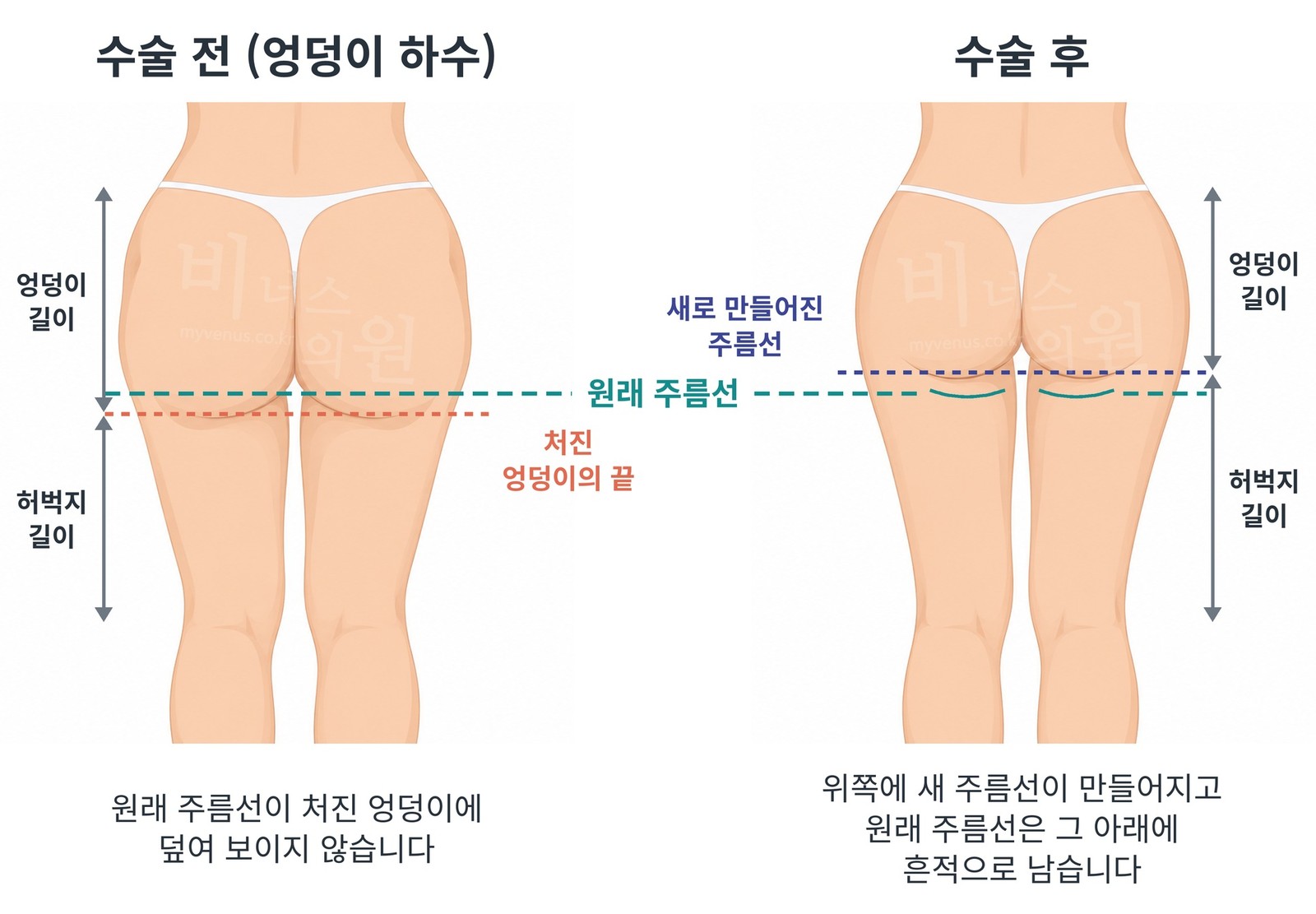 엉덩이 하수 지방흡입 수술 전과 수술 후의 후면 비교 — 수술 후 위쪽에 새로 만들어진 주름선과 그 아래에 흔적으로 남은 원래 주름선