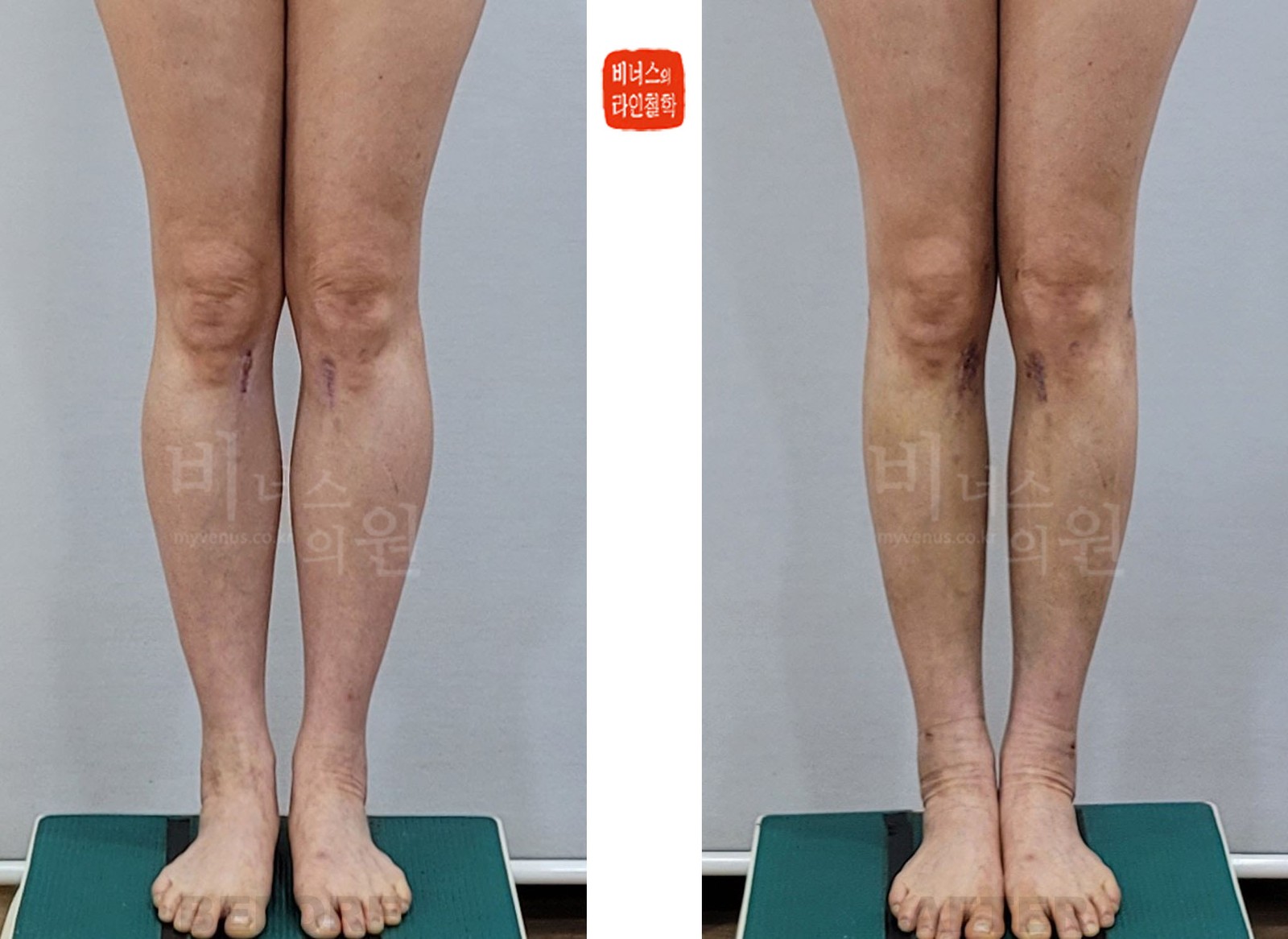 종아리 원통형·무릎 내측 지방흡입 전후사진 다리를 붙인 정면 (수술 후 10일)