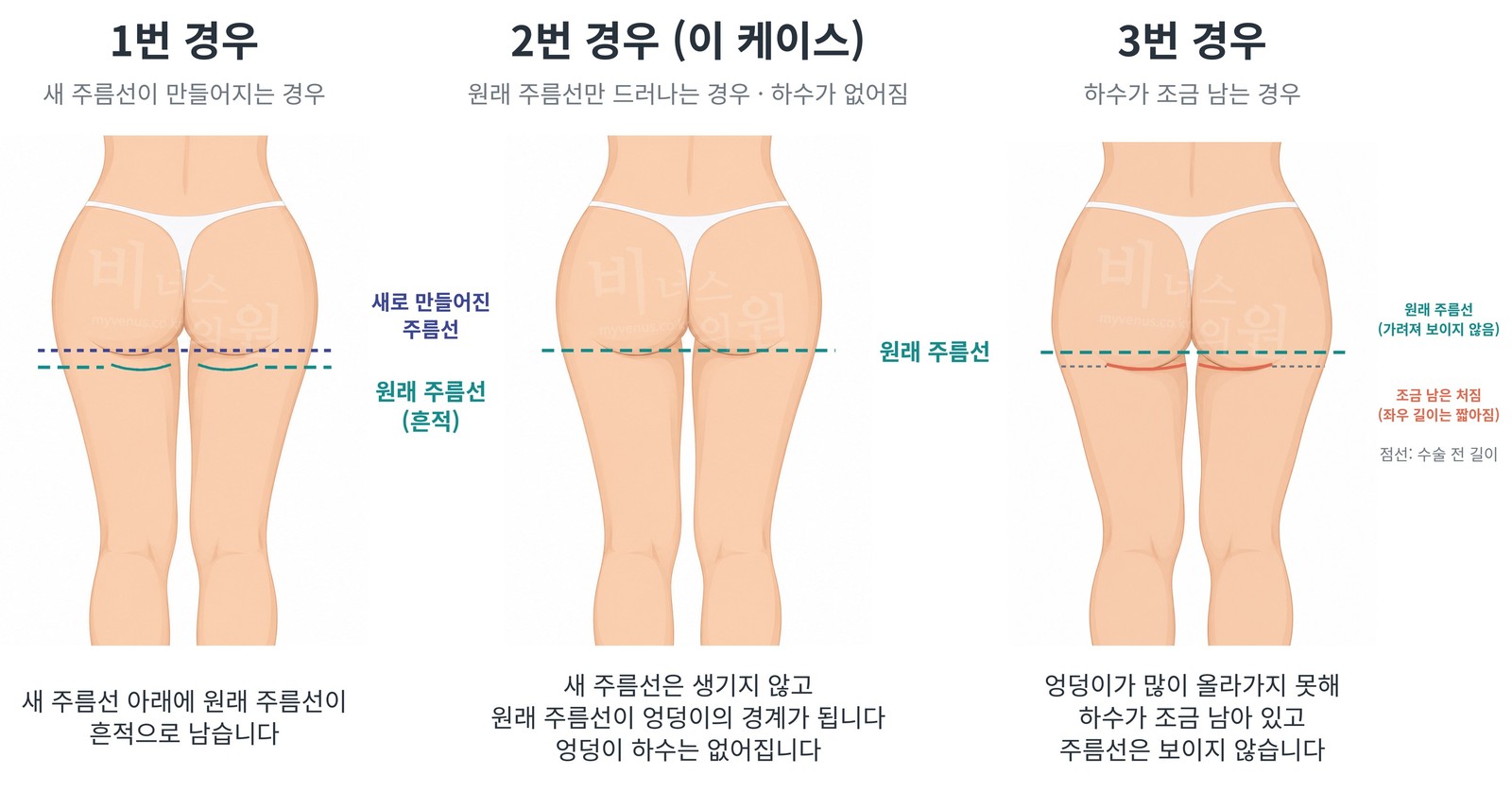 수술 후 주름선의 세 가지 모습 비교 — 1번 새 주름선이 만들어지는 경우, 2번 원래 주름선만 드러나는 경우, 3번 하수가 조금 남는 경우