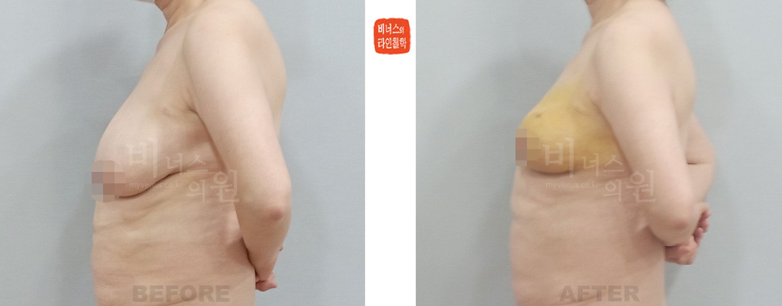 짝짝이 유방 좌측 지방흡입 전후사진 좌측면 (수술 후 1주일)