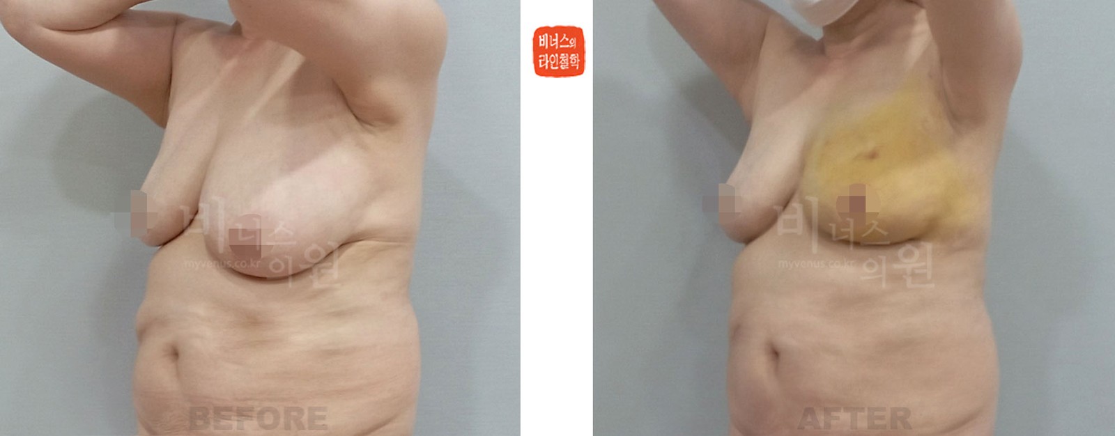 짝짝이 유방 좌측 지방흡입 전후사진 좌측 45도 측면 (수술 후 1주일)