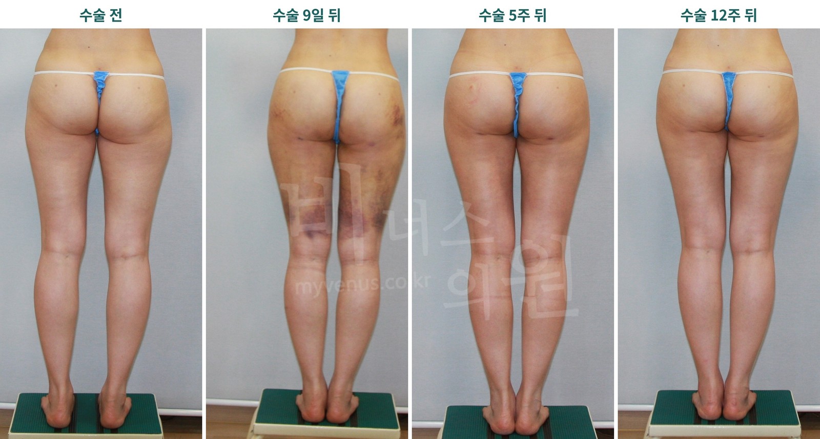 허벅지 엉덩이 지방흡입 후 회복 경과 후면 사진 — 수술 전 9일 5주 12주