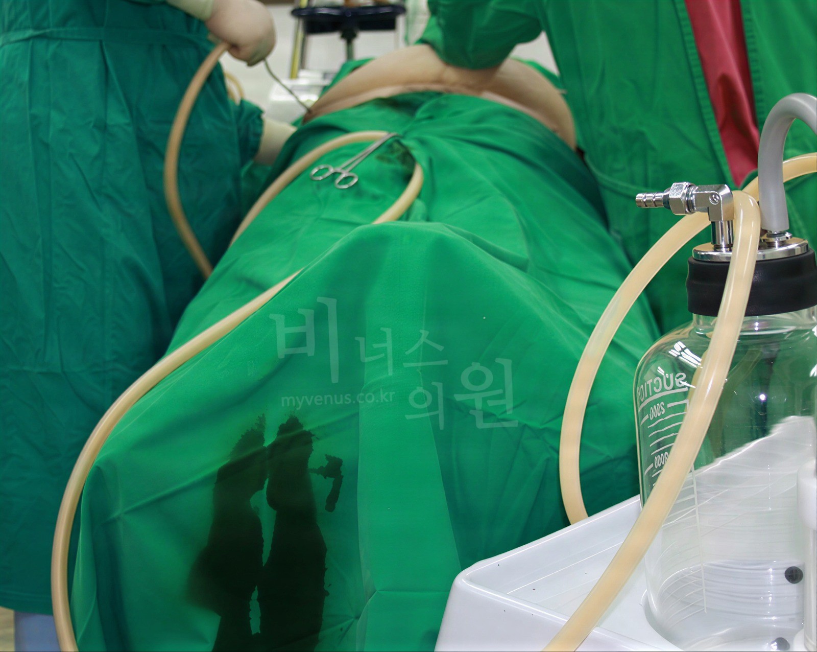 수술 중 흡입관을 통해 지방이 석션 병으로 들어가는 모습