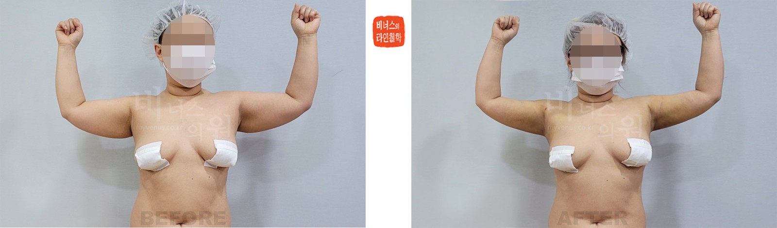 팔 전체와 겨드랑이 앞뒤 지방흡입 전후사진 전면 (수술 후 1주일)
