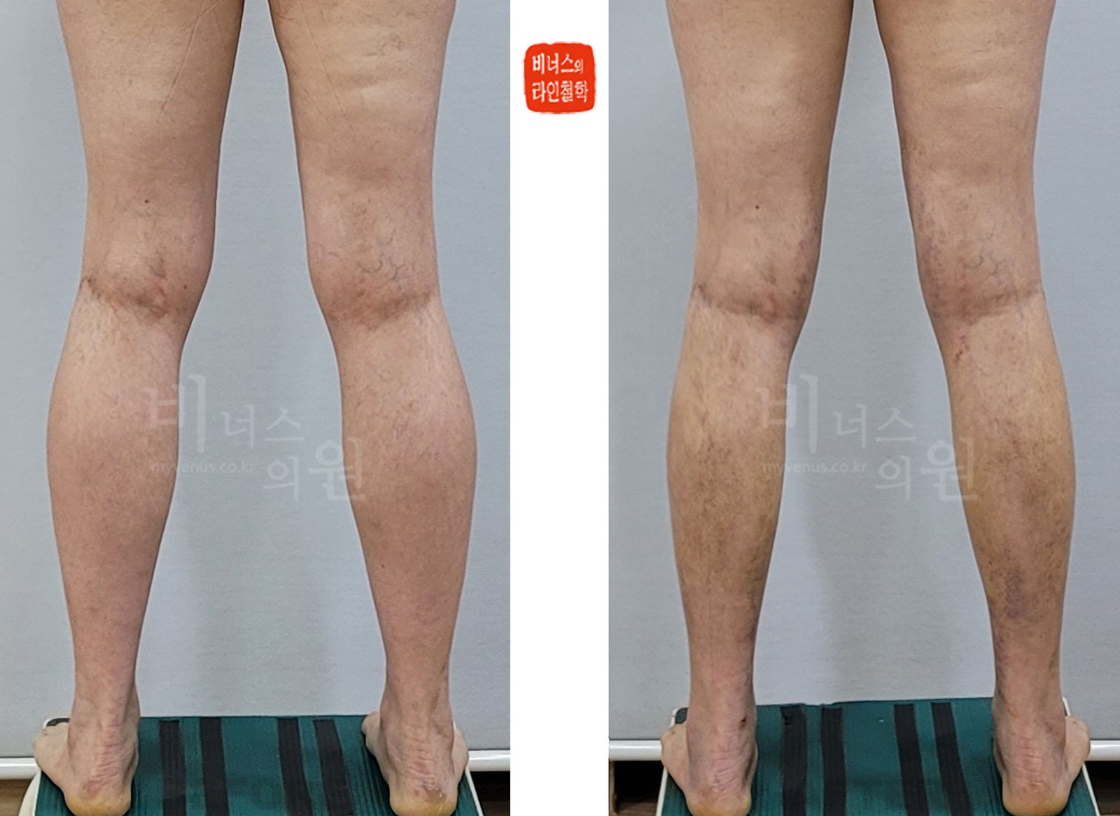 종아리 지방흡입 전후사진 첫 번째 케이스 후면, 다리를 벌린 모습 (수술 후 10일)