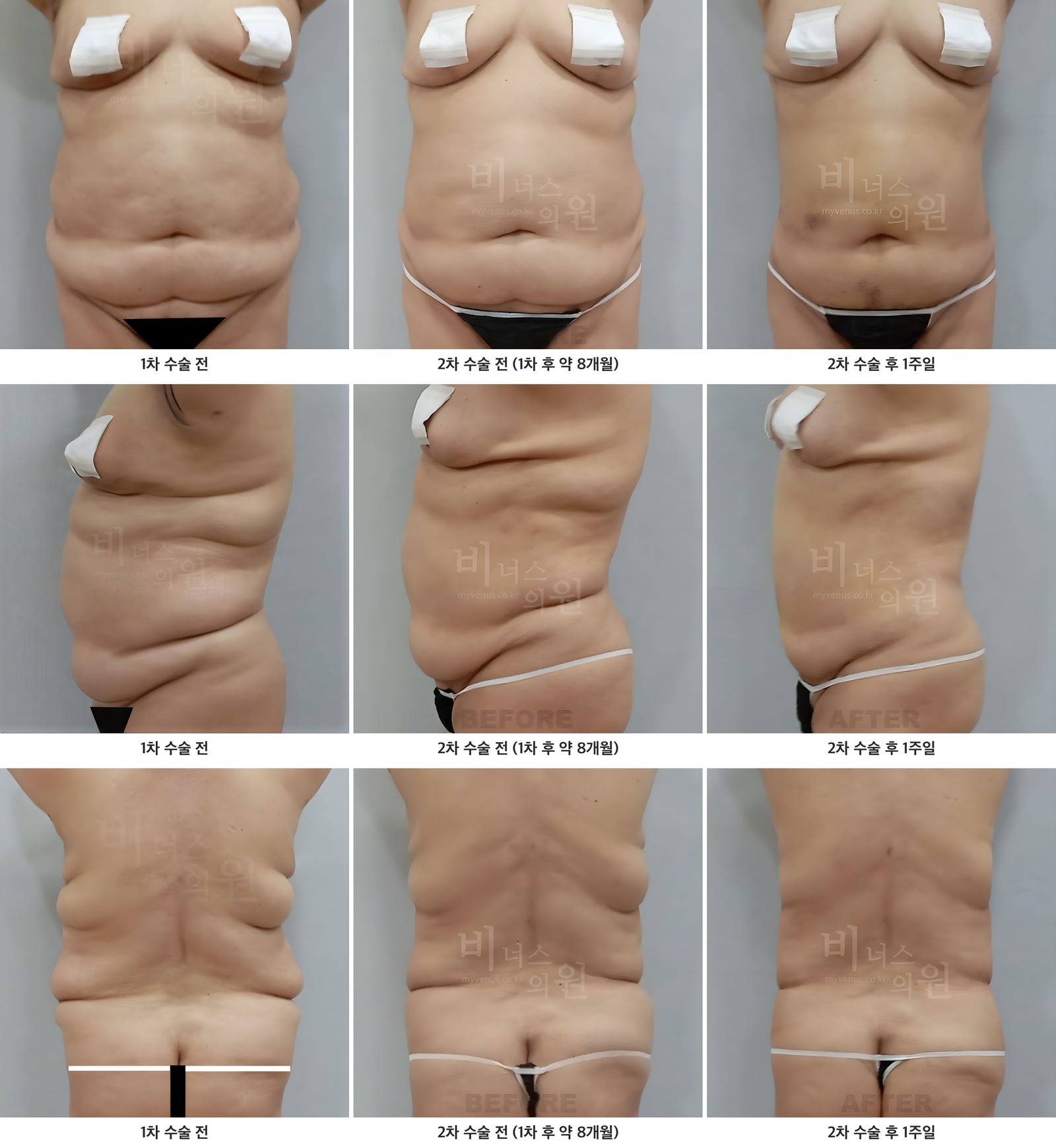 복부 2차 지방흡입 전후사진 첫 번째 케이스 — 정면·측면·후면의 1차 수술 전, 2차 수술 전, 2차 수술 후 1주일