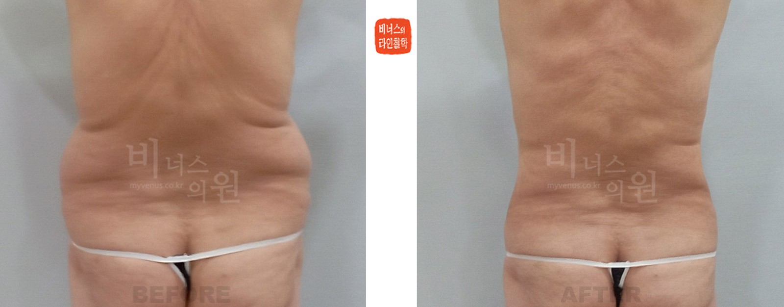 복부의 늘어진 피부 지방흡입 전후사진 후면 (수술 후 1주일)