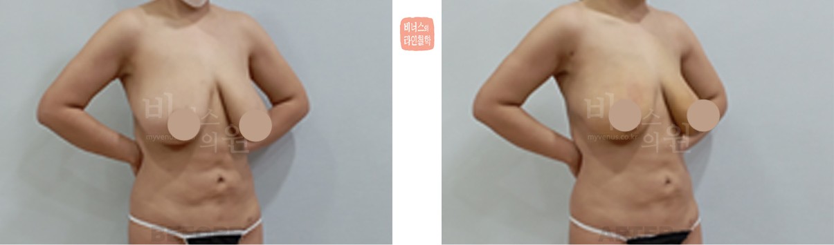 유방 지방흡입 축소 전후사진 우측 사면 (수술 후 1개월)