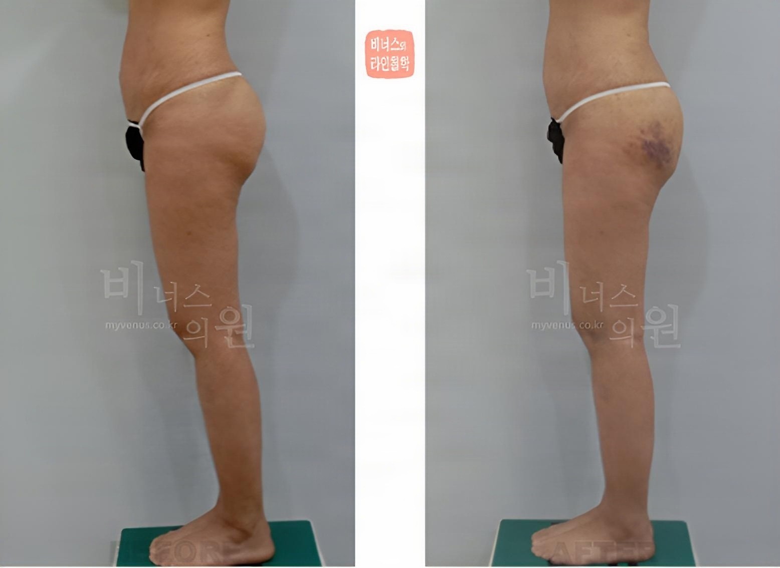 엉덩이 볼륨업 지방흡입 전후사진 좌측면 (수술 후 약 2주)