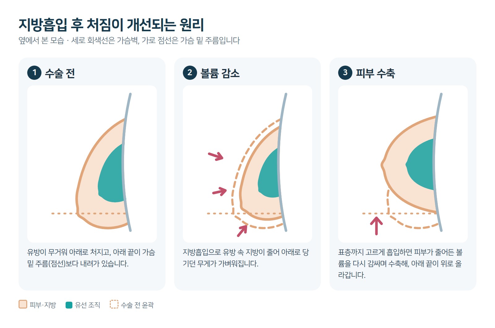 지방흡입 후 볼륨 감소와 피부 수축으로 처짐이 개선되는 원리 도해