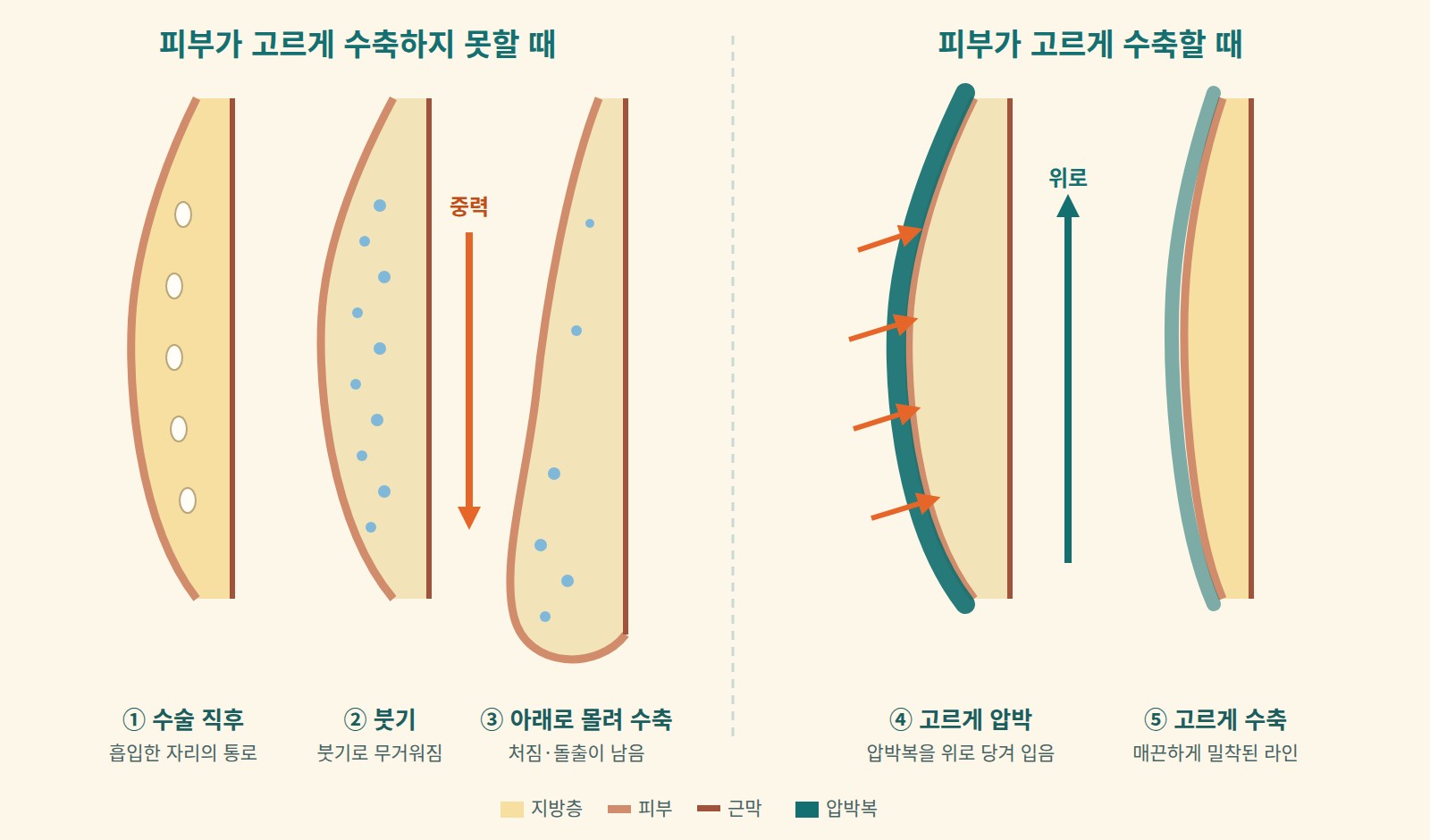 피부가 고르게 수축하지 못할 때 처짐과 돌출이 남는 과정과, 압박복으로 고르게 압박해 균일하게 수축하는 과정을 나타낸 단면 도해