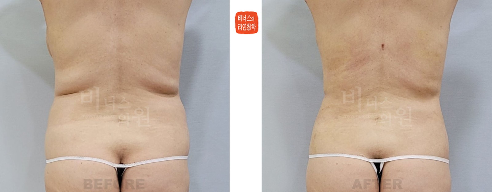 복부 재수술과 등 지방흡입 전후사진 후면 (수술 후 2주)