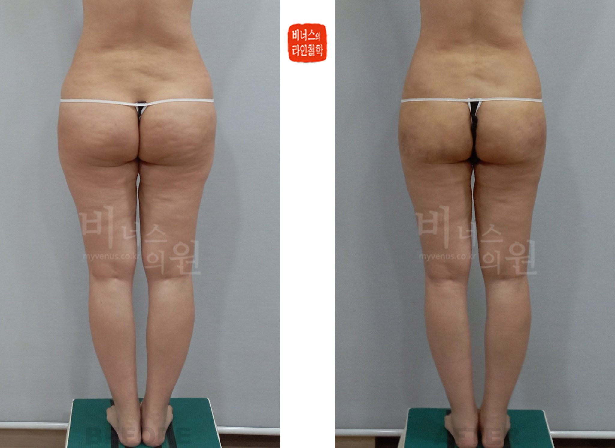 엉덩이 지방흡입 수술 전 후면 힙 돌출 실루엣