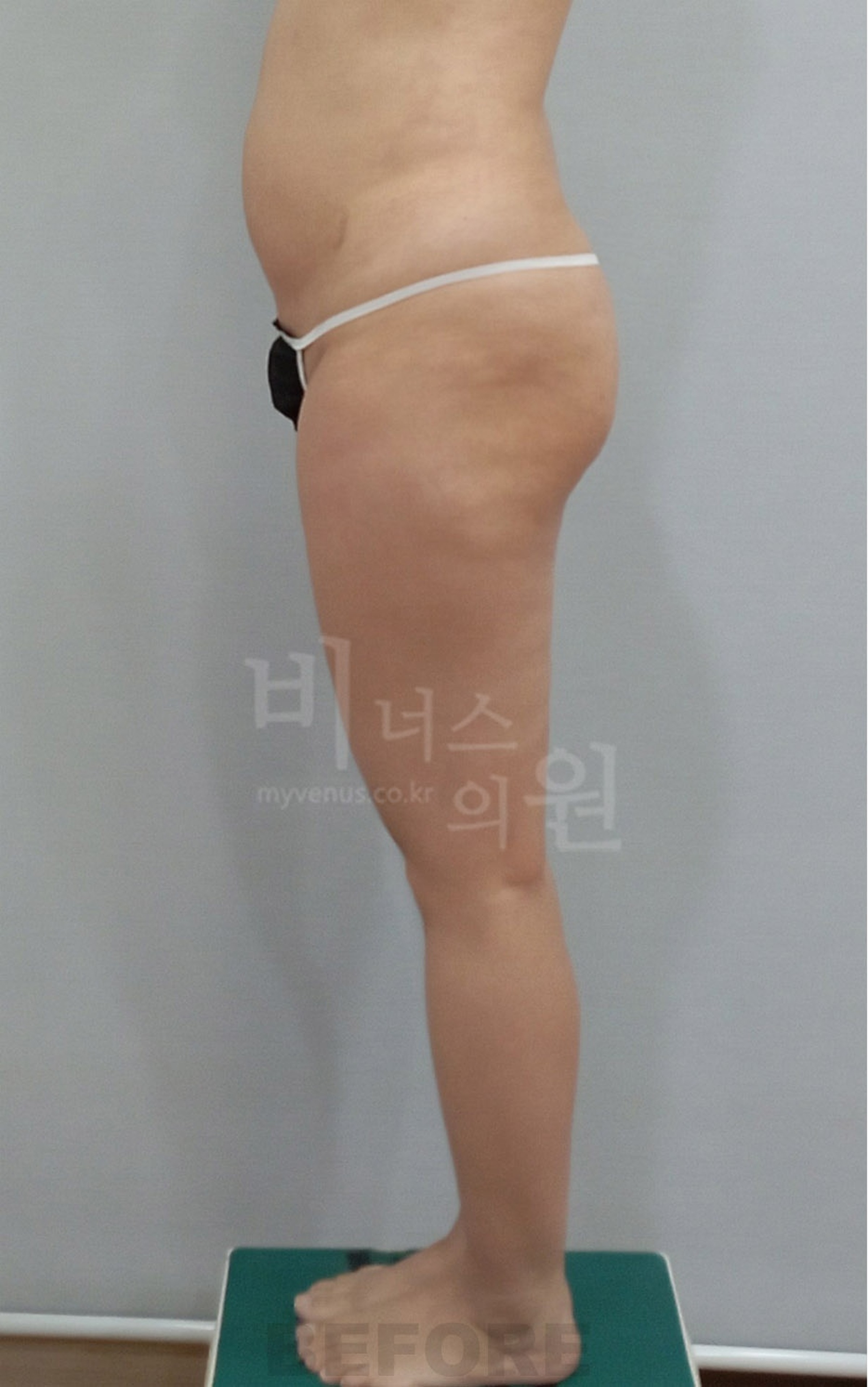 엉덩이 지방흡입 수술 전 우측면 — 힙 하방 돌출