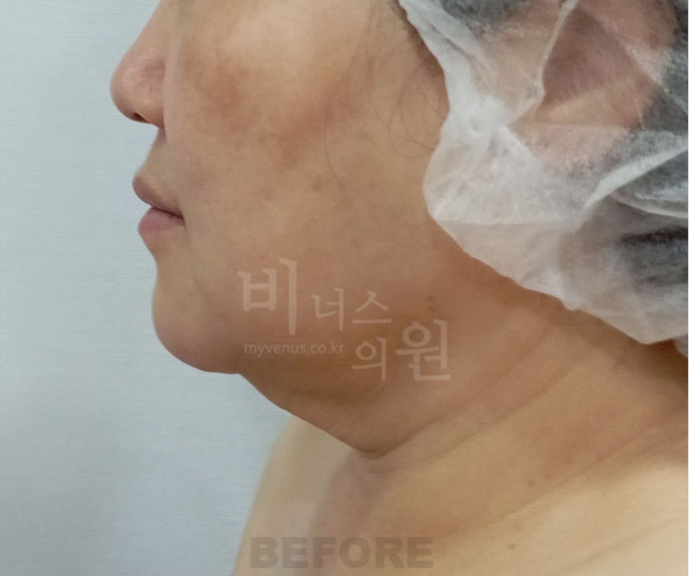 이중턱 턱라인 지방흡입 수술 전 우측면