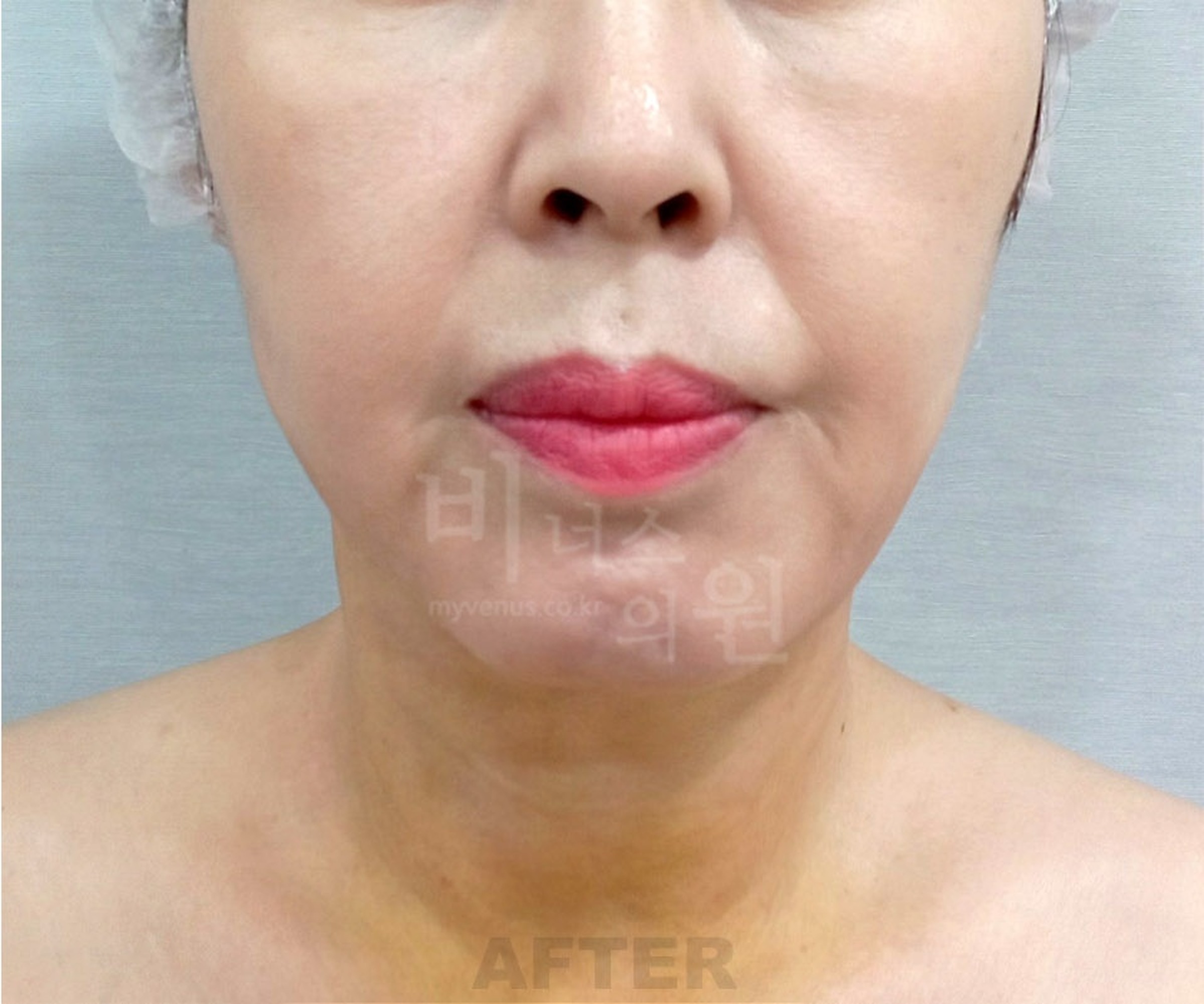 이중턱 목 지방흡입 수술 후 정면