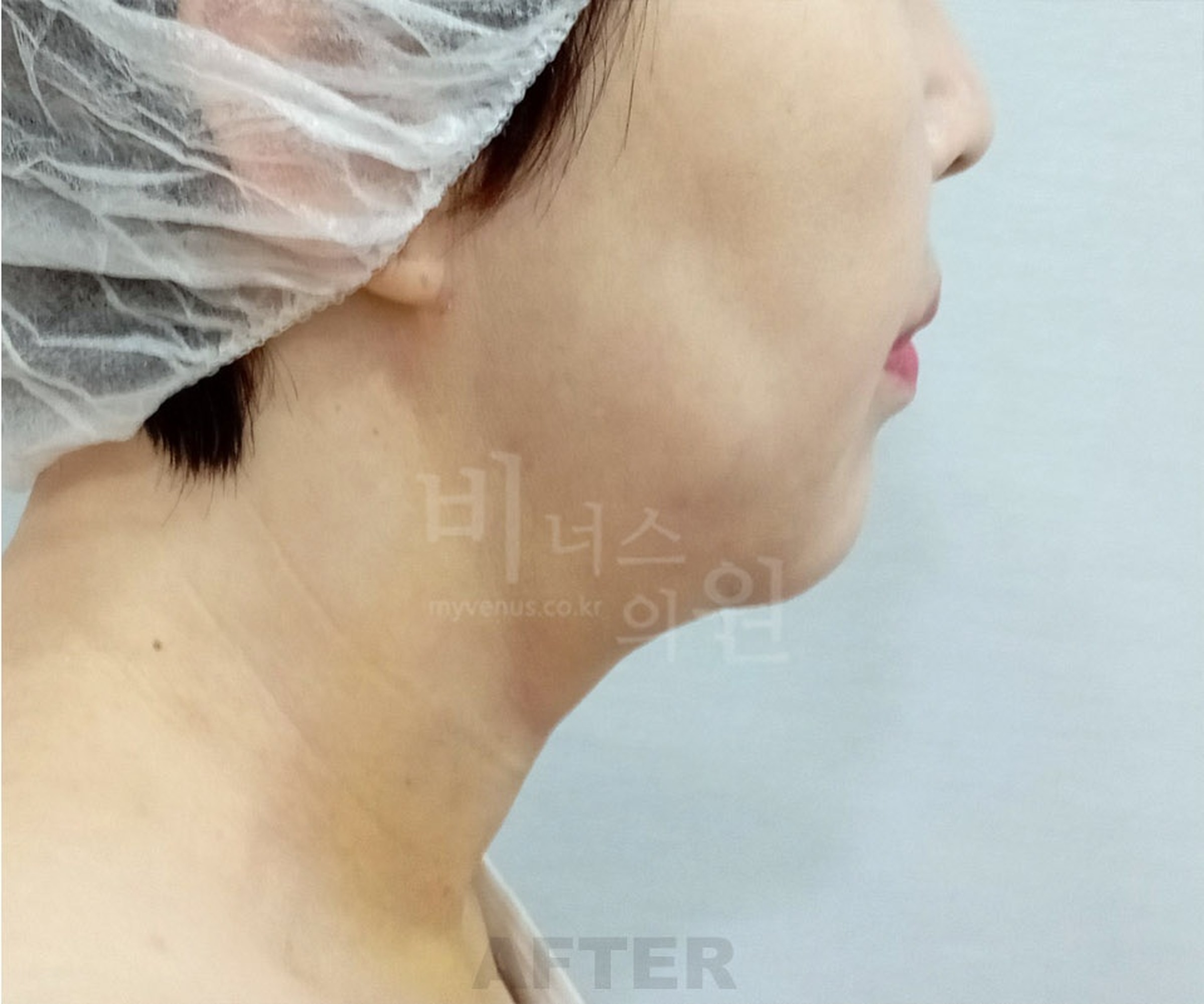 이중턱 목 지방흡입 수술 후 좌측면