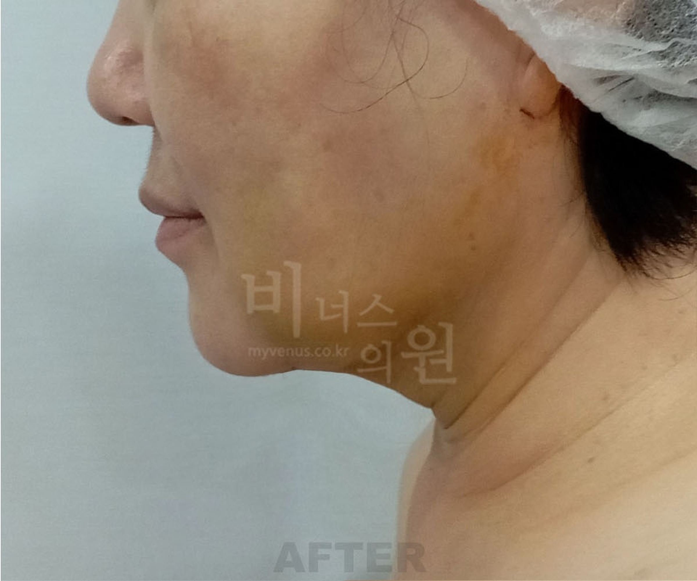 이중턱 턱라인 지방흡입 수술 후 좌측면