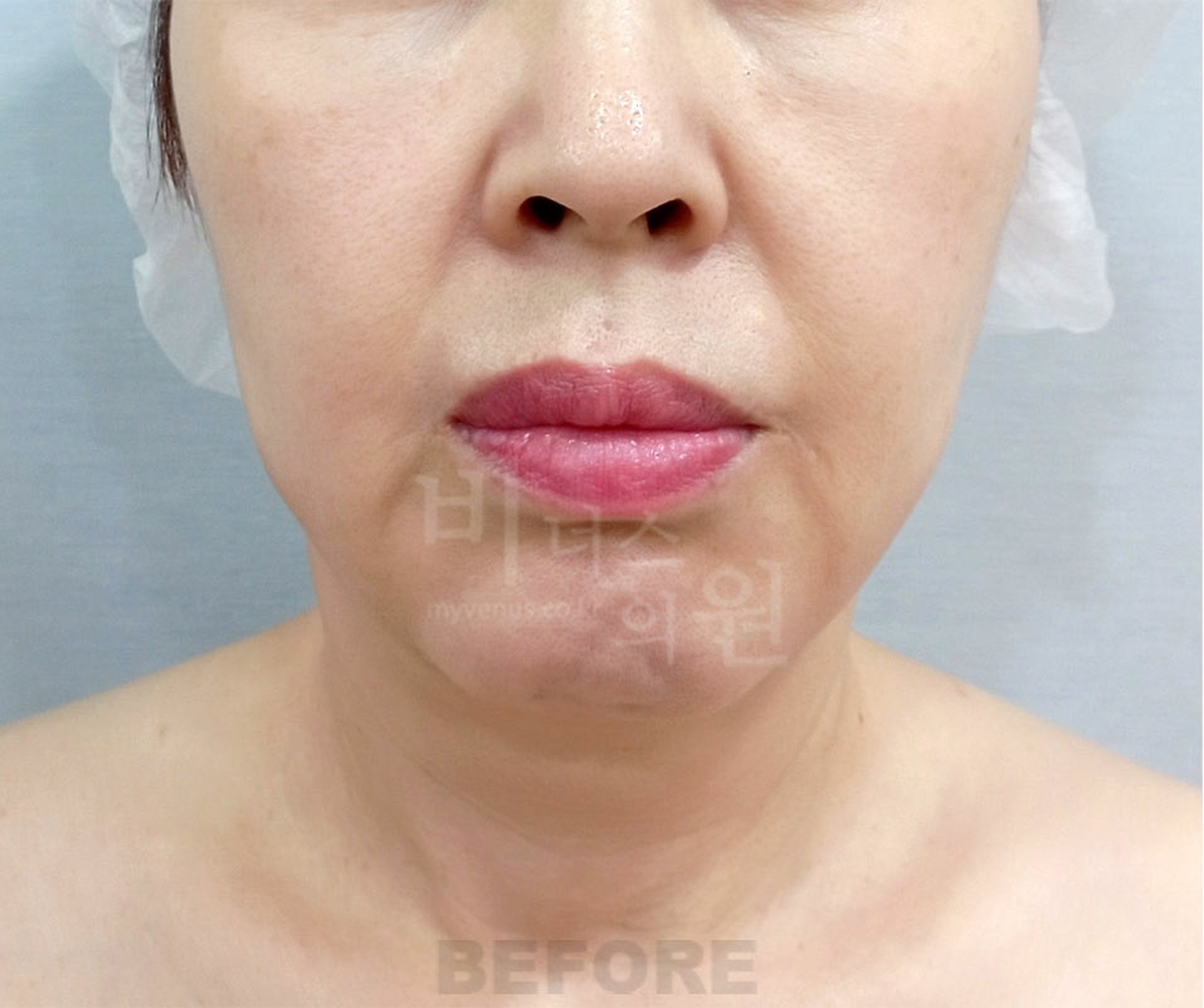 이중턱 목 지방흡입 수술 전 정면