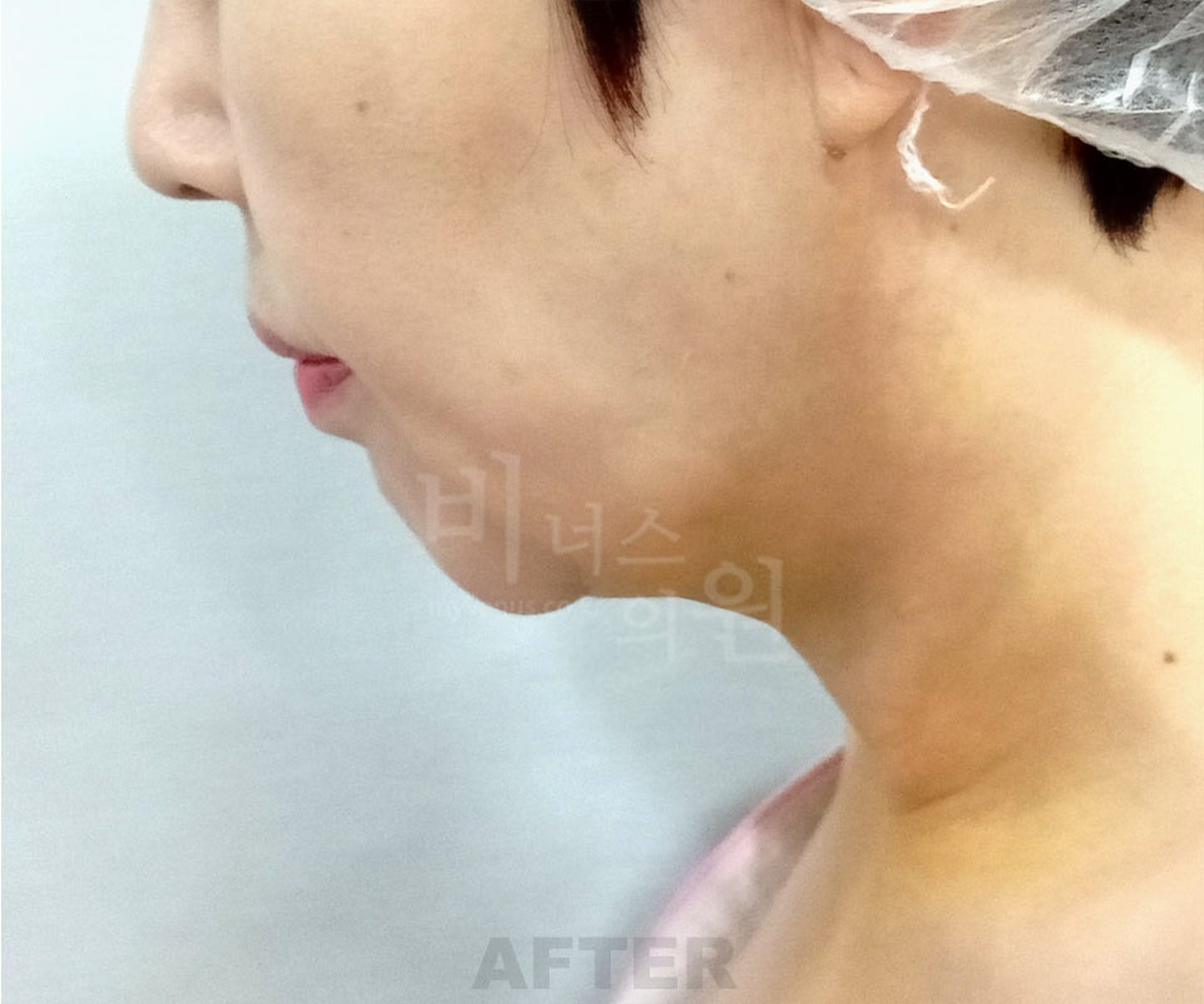 이중턱 목 지방흡입 수술 후 우측면 고개숙임