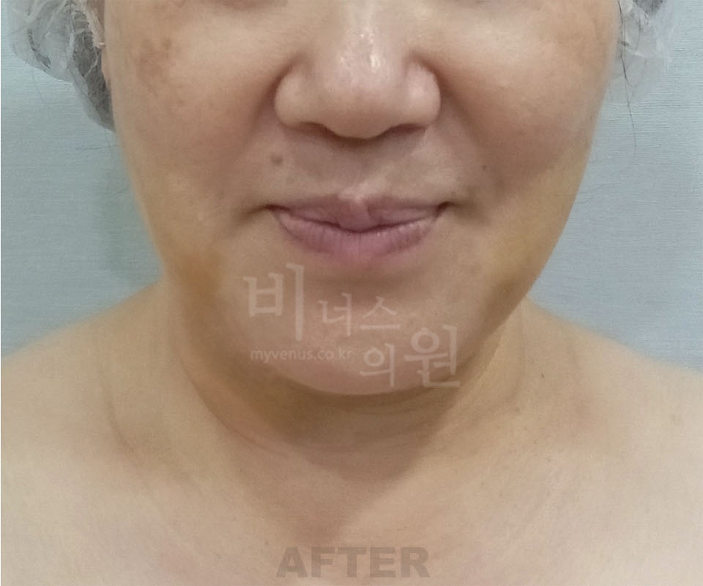 이중턱 턱라인 지방흡입 수술 후 정면