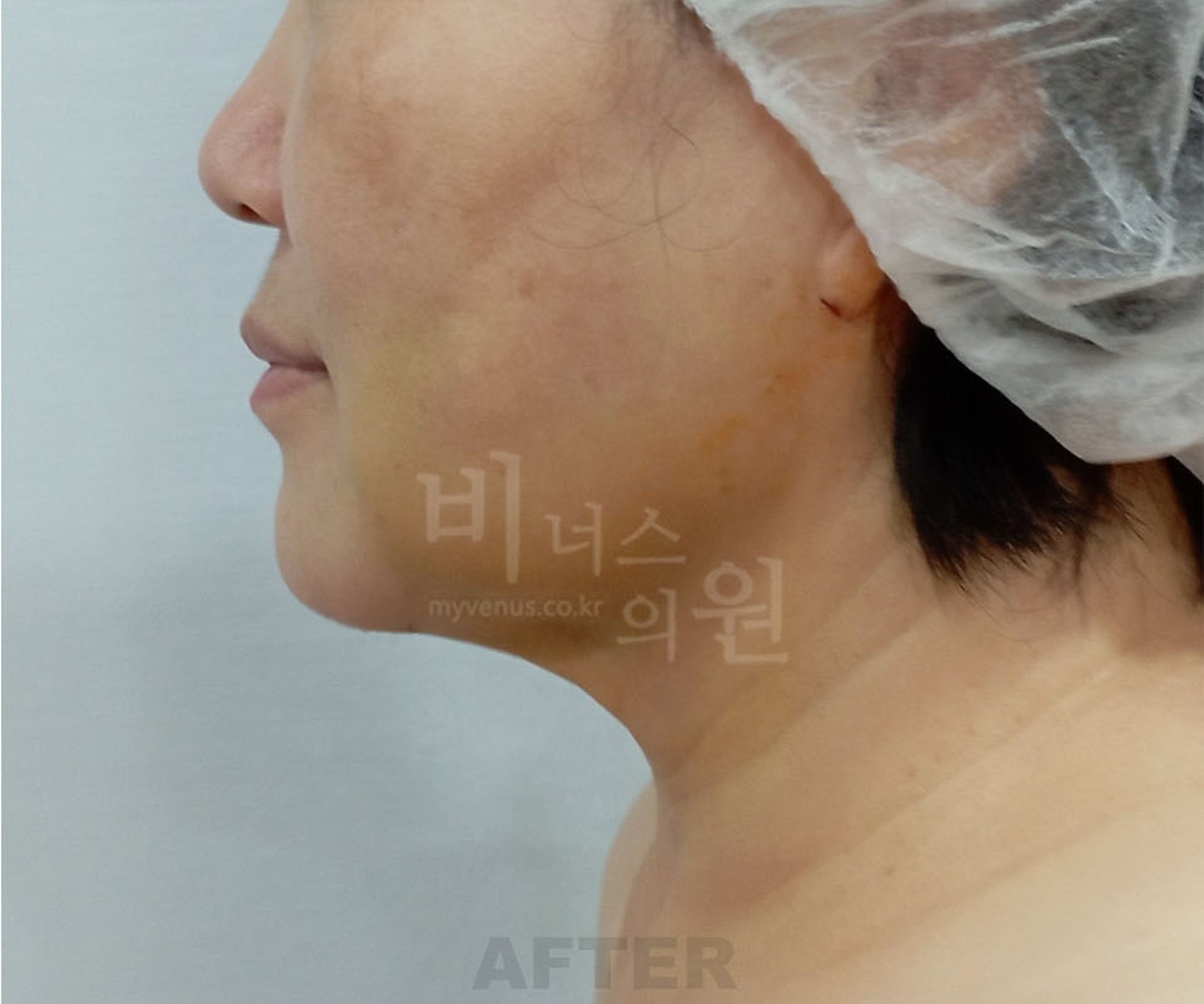 이중턱 턱라인 지방흡입 수술 후 우측면