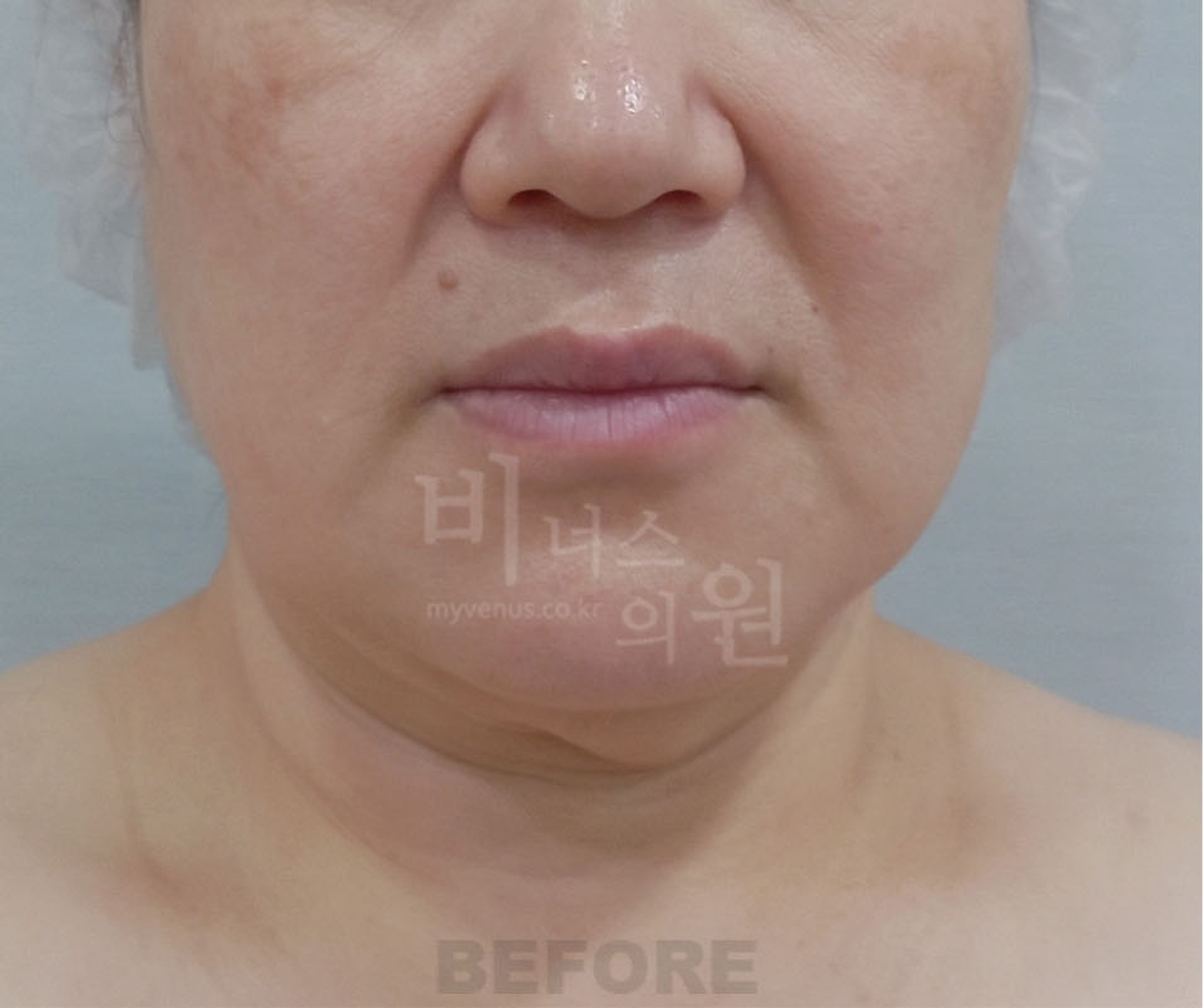 이중턱 턱라인 지방흡입 수술 전 정면