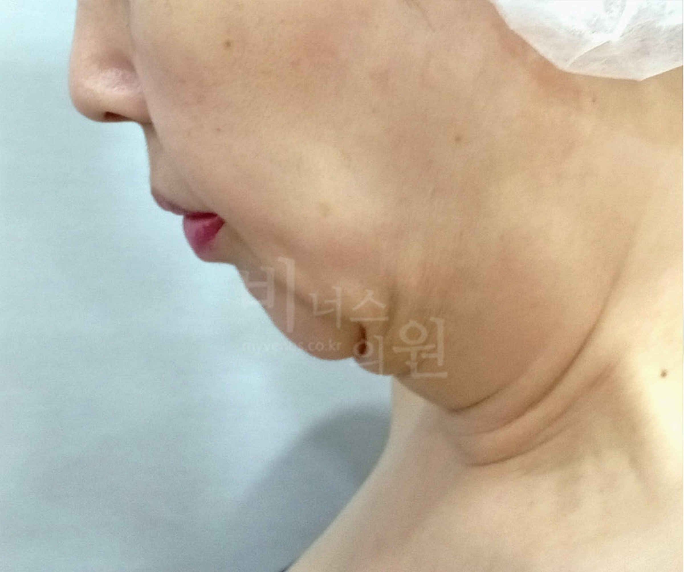 이중턱 목 지방흡입 수술 전 우측면 고개숙임