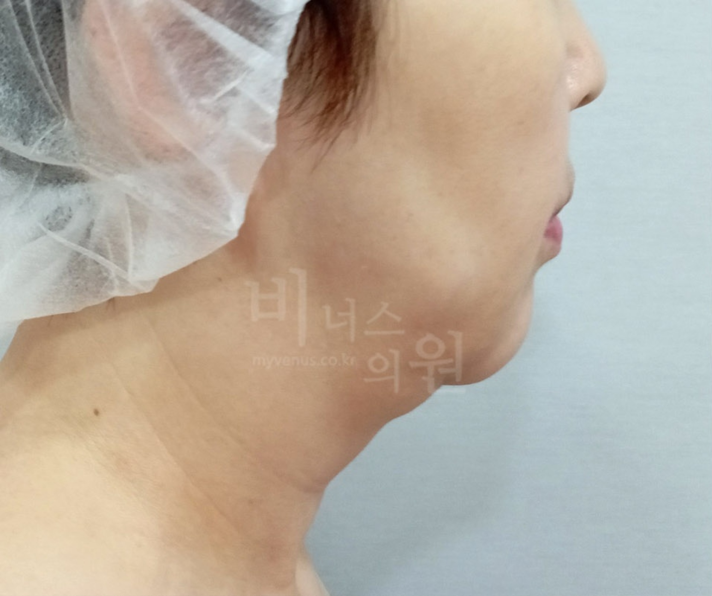 이중턱 목 지방흡입 수술 전 좌측면