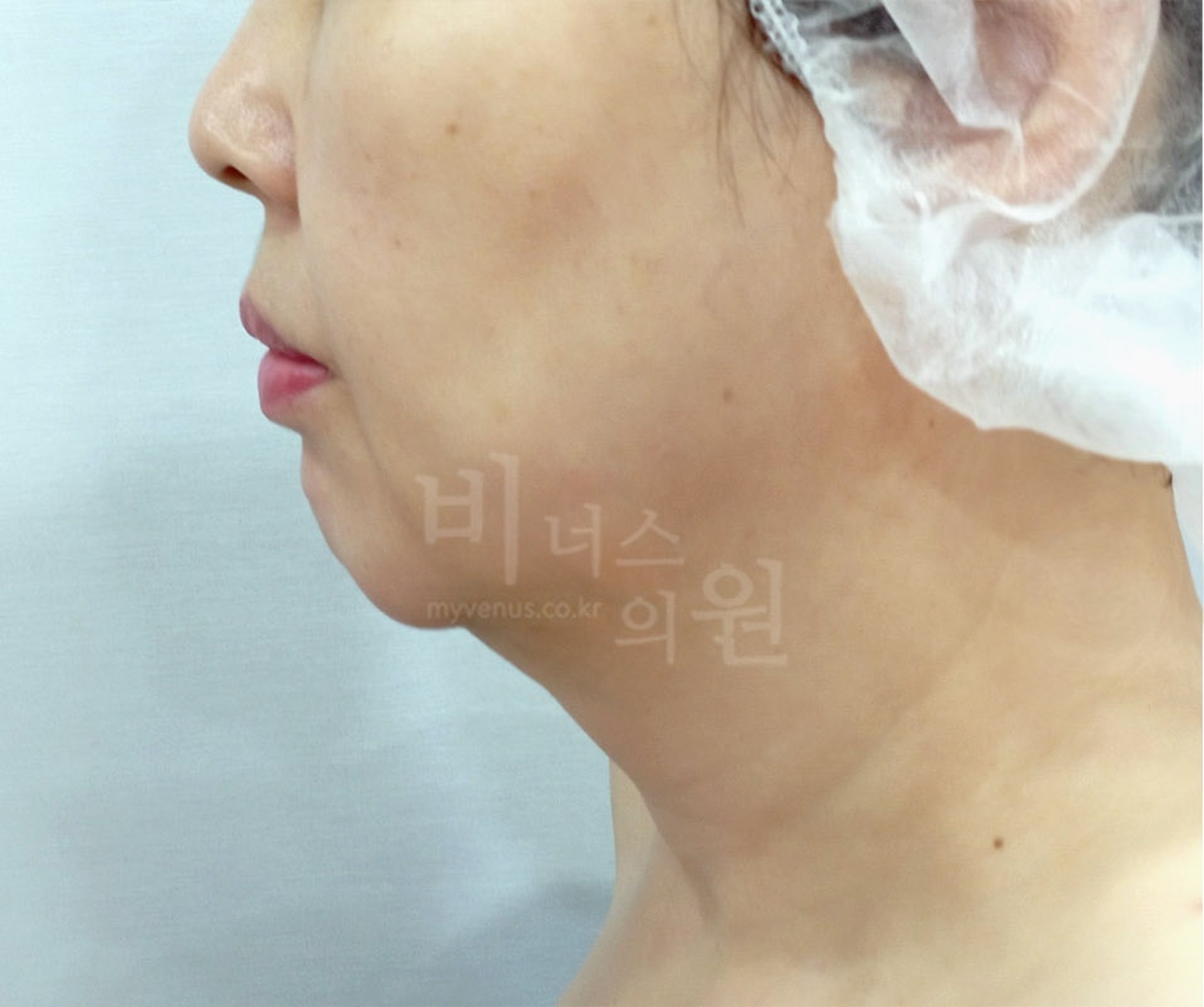 이중턱 목 지방흡입 수술 전 우측면