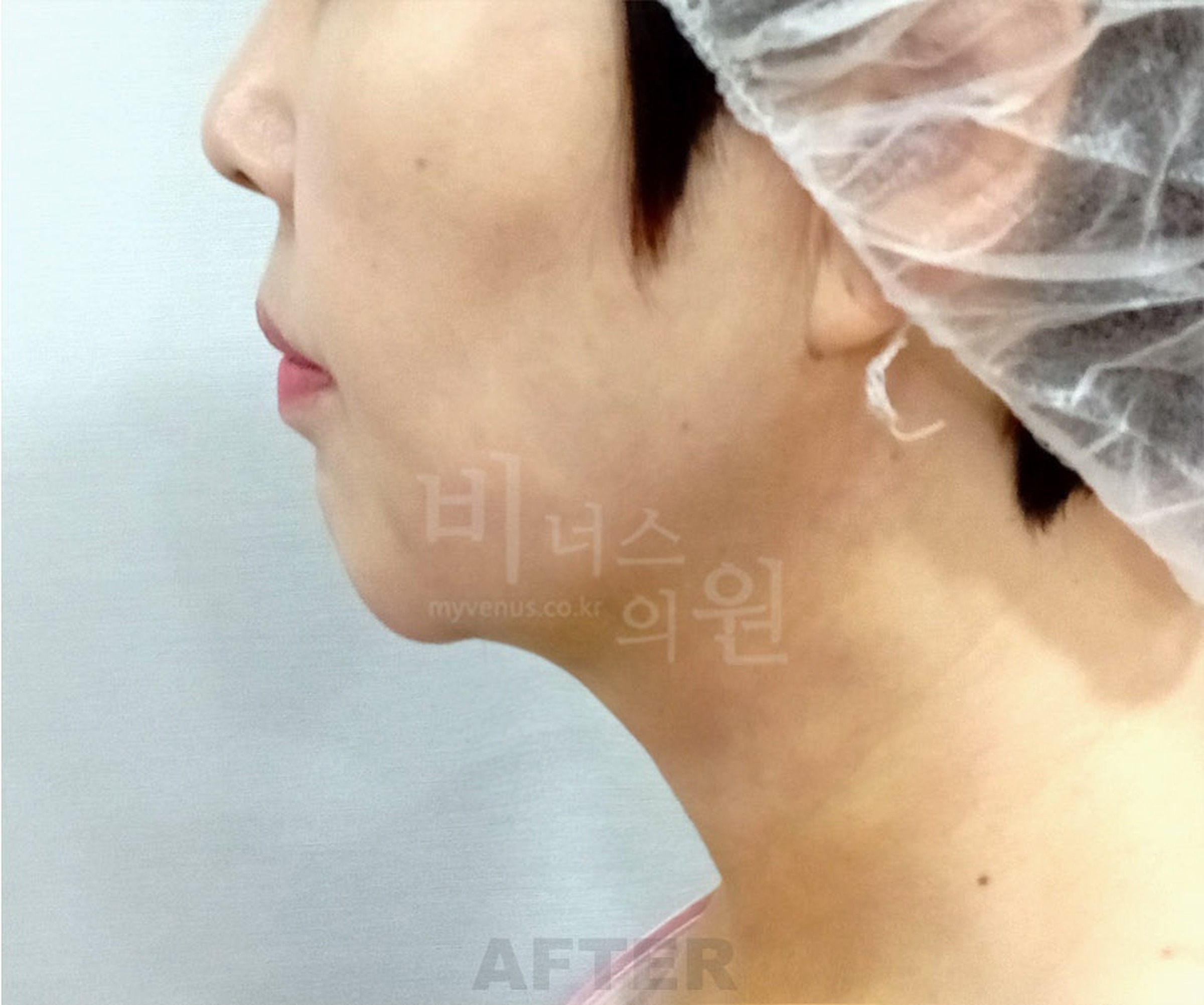 이중턱 목 지방흡입 수술 후 우측면