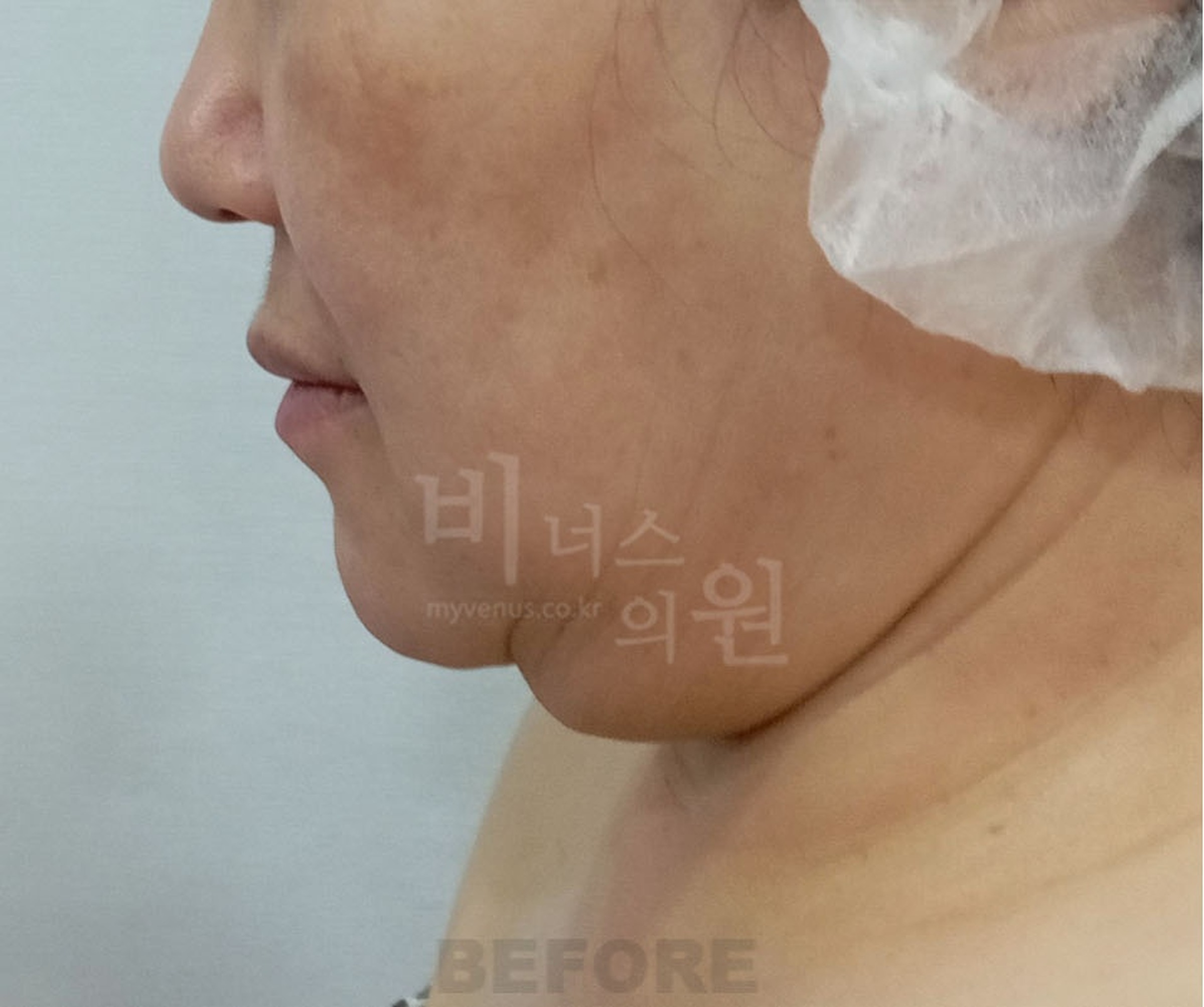 이중턱 턱라인 지방흡입 수술 전 좌측면