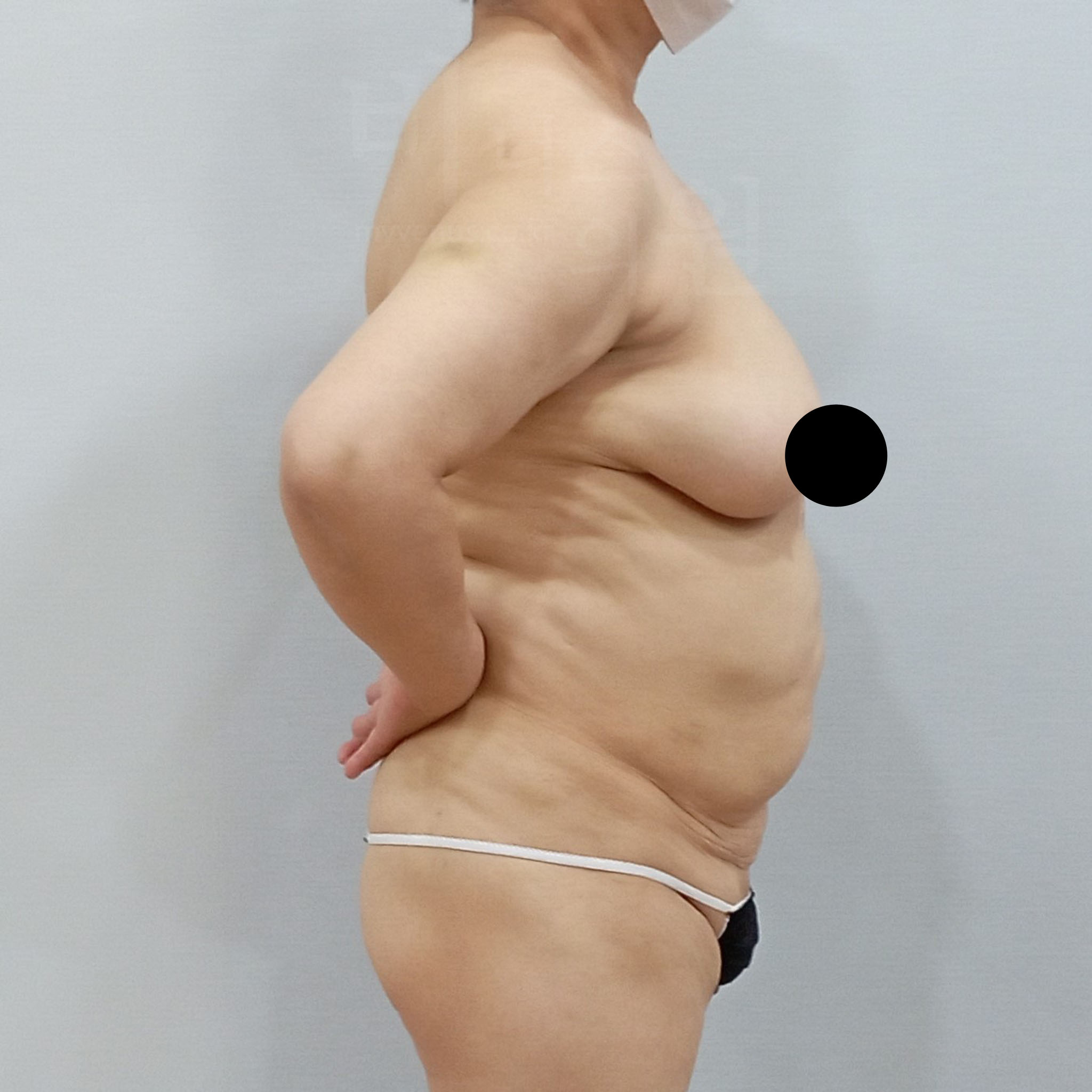 가슴축소 지방흡입 수술 전 측면