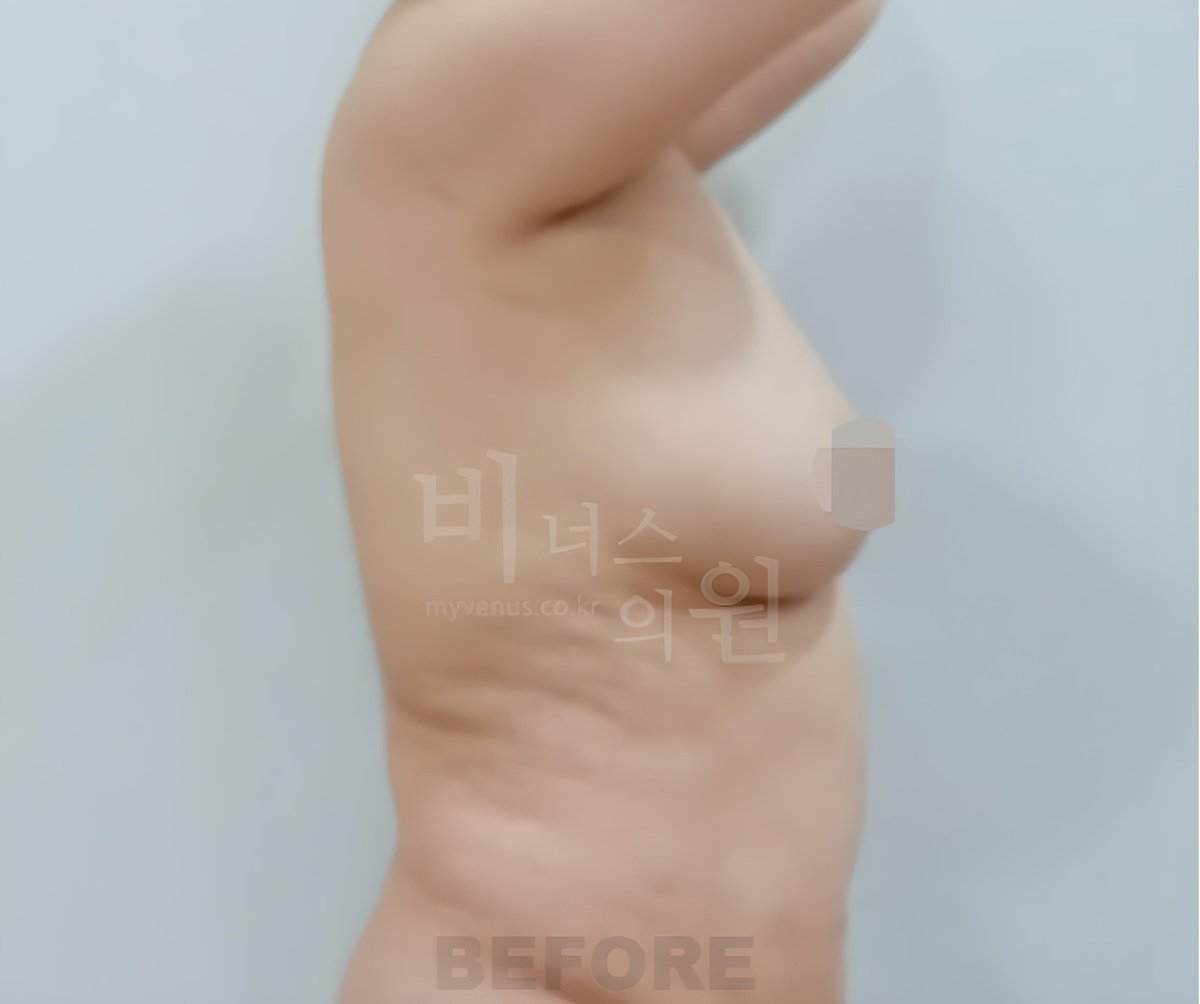 가슴축소 지방흡입 수술 전 측면 90도 — 유방 하부 두꺼운 돌출