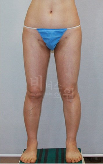 허벅지 맥시머C 지방흡입 수술 후 정면 2